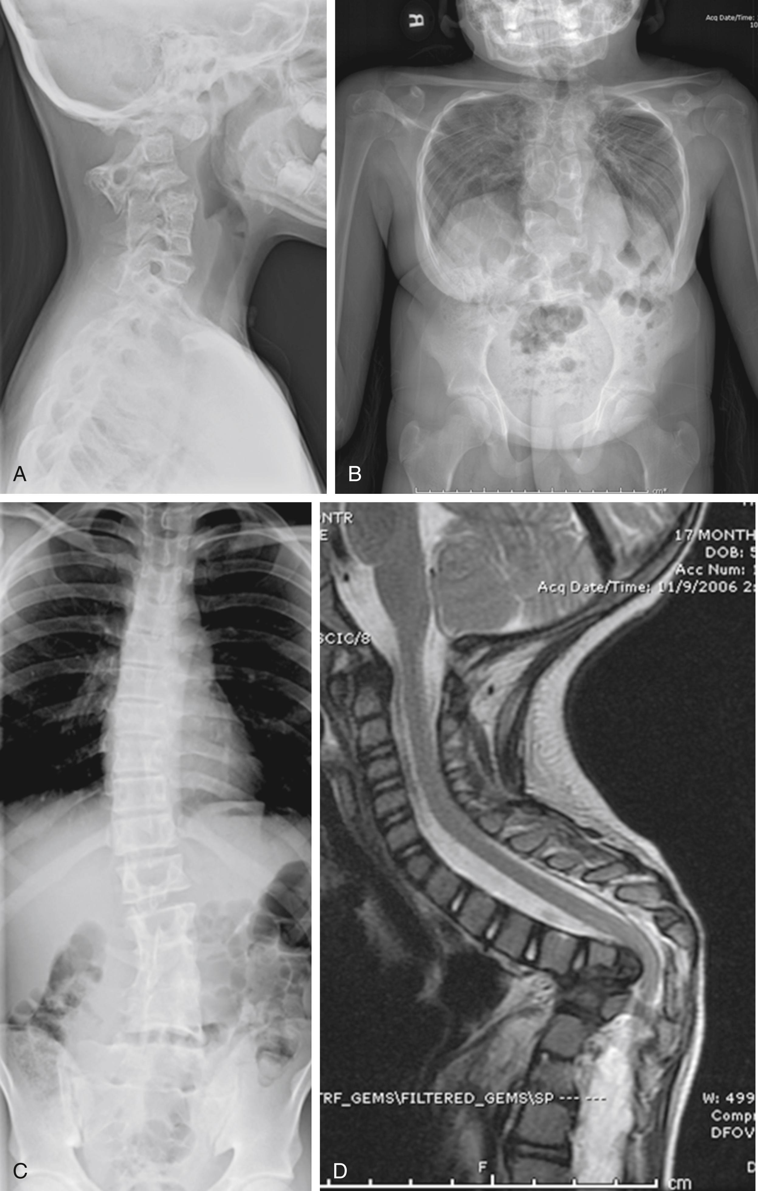 Fig. 19.1, Congenital spinal deformity encompasses a wide range of severities and locations of vertebral anomalies. A, Klippel–Feil deformity with neck pain and myelomalacia; B, Jarcho–Levin syndrome (spondylocostal dysostosis) with no respiratory symptoms in spite of severe shortening of the torso; C, lumbar block vertebra with activity-related pain at the junction with normally segmented spine; D, segmental spinal dysgenesis with progressive paraparesis.