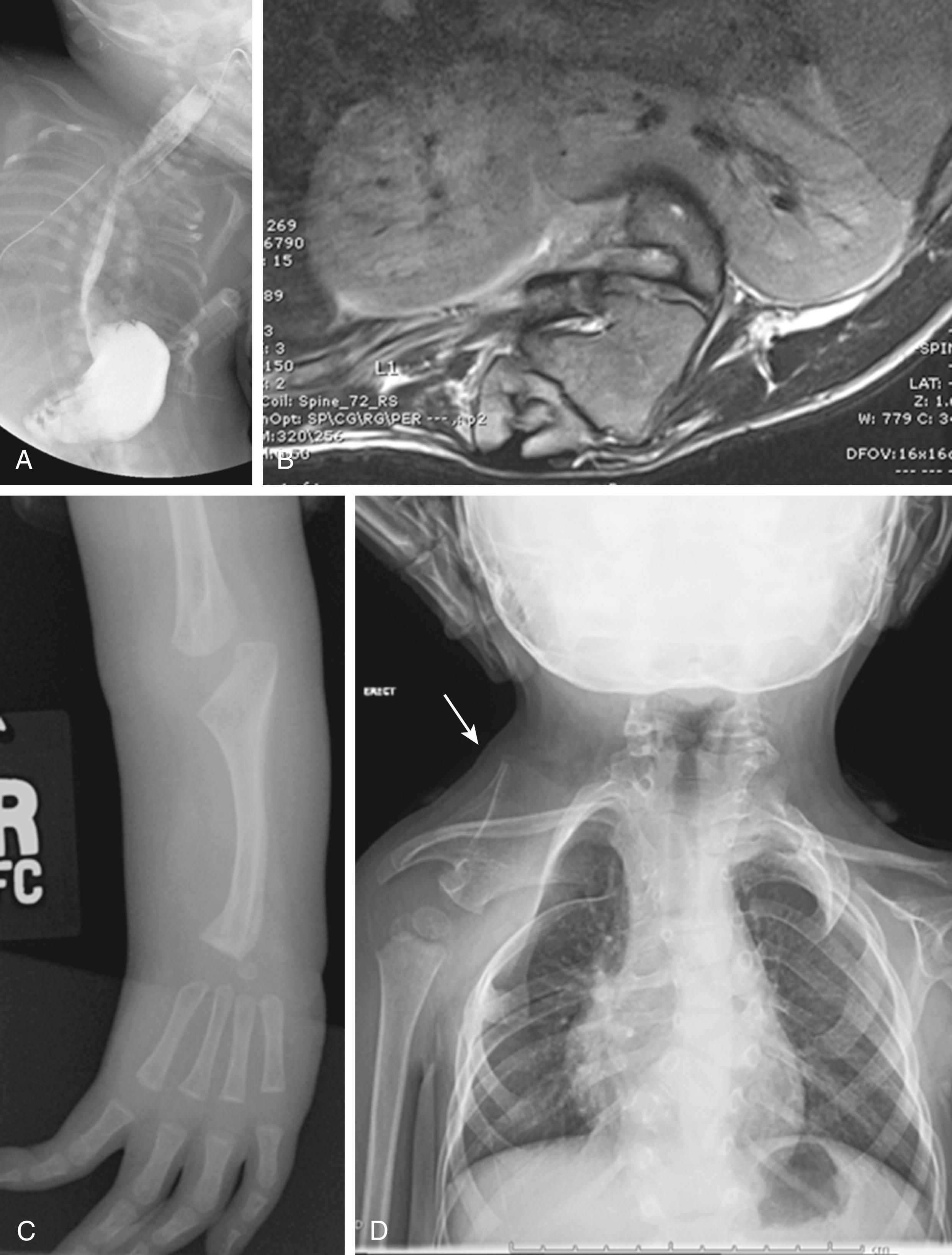 Fig. 19.2, Multiple skeletal and visceral anomalies commonly accompany congenital spinal deformity. Screening should include a search for cardiac, renal, and neuraxis anomalies. A, Esophageal atresia in a patient with vertebral, anal, cardiac, tracheoesophageal fistula, renal, and limb (VACTERL) syndrome; B, horseshoe kidney in association with spinal dysgenesis; C, radial aplasia in a patient with VACTERL syndrome; D, Sprengel deformity in a patient with Klippel–Feil syndrome and other vertebral anomalies. Arrow points to abnormal, high-riding scapula.