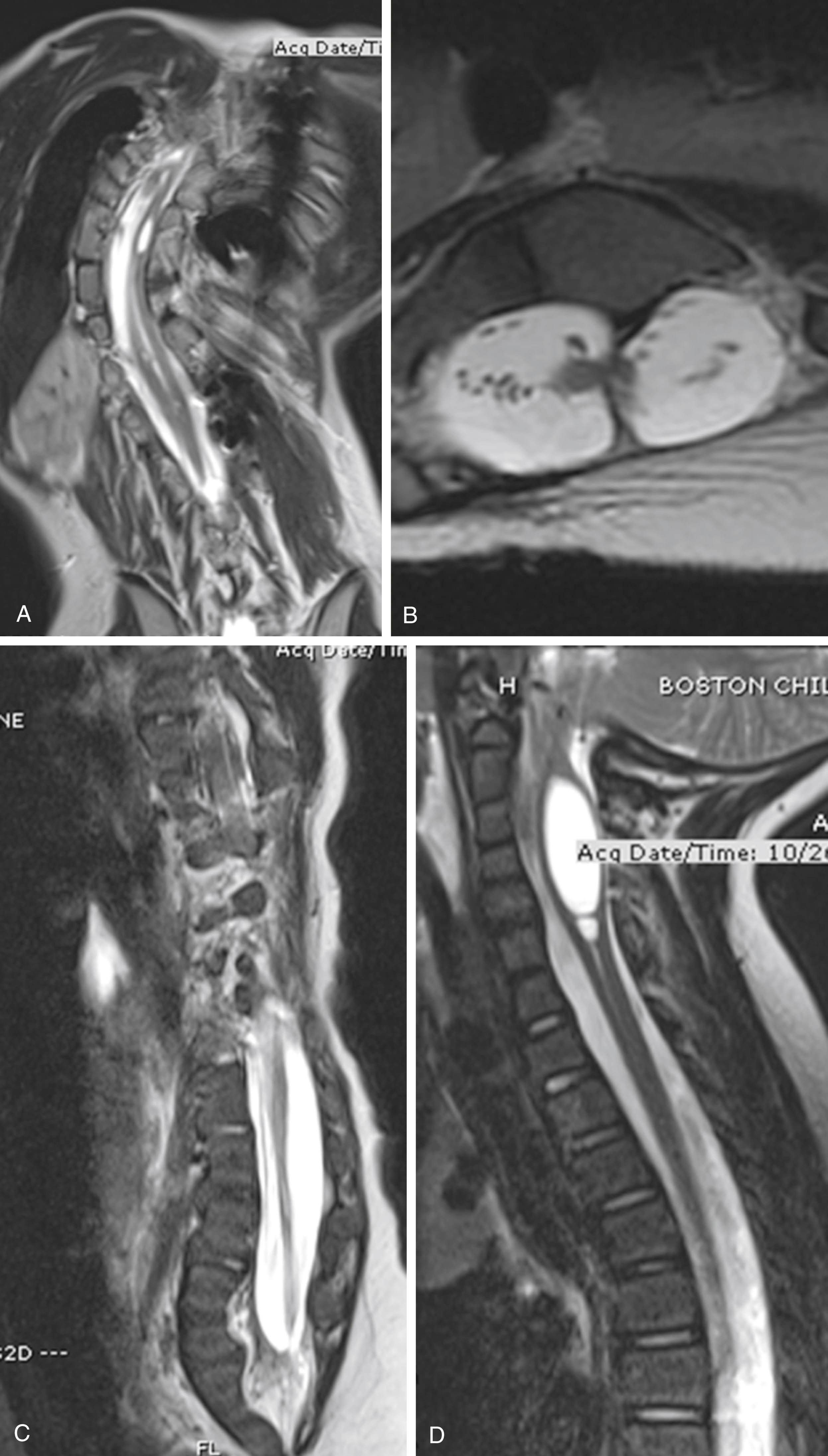 Fig. 19.3, A high percentage of vertebral anomalies manifest associated neuraxis anomalies. A, Diplomyelia and small syrinx in a patient with multiple vertebral anomalies and rib fusions; B, diastematomyelia in a patient with congenital kyphosis; C, thickened filum and tethered cord in a patient with lumbar congenital scoliosis; D, mild Chiari 1 and cervical syrinx in a patient with Klippel–Feil syndrome.