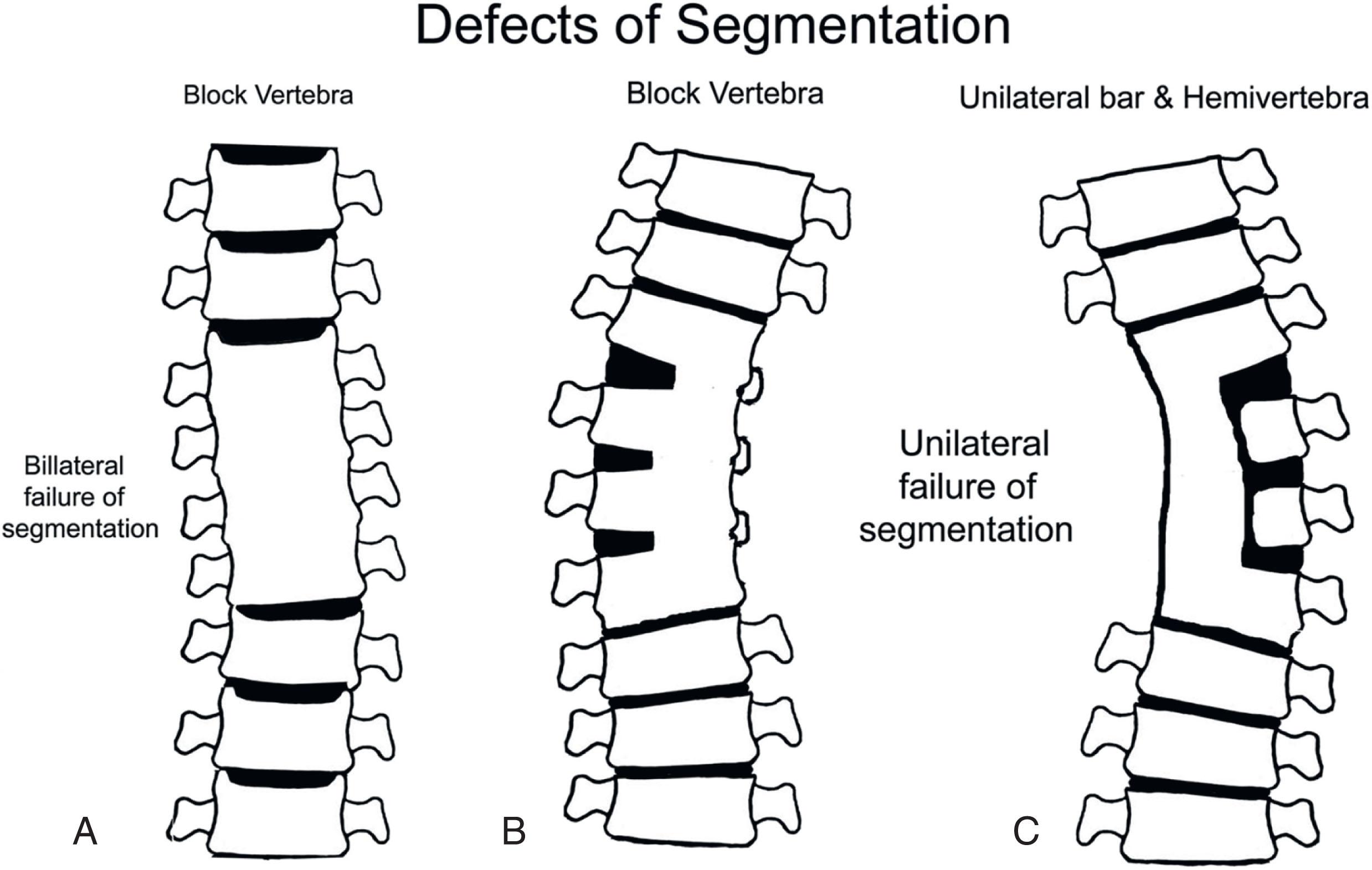 Fig. 22.1, Congenital scoliosis resulting from failure of formation (A), failure of segmentation (B), and mixed deformity with failure of formation with contralateral failure of segmentation (C), which creates a high risk of progression and often requires surgery at a young age.