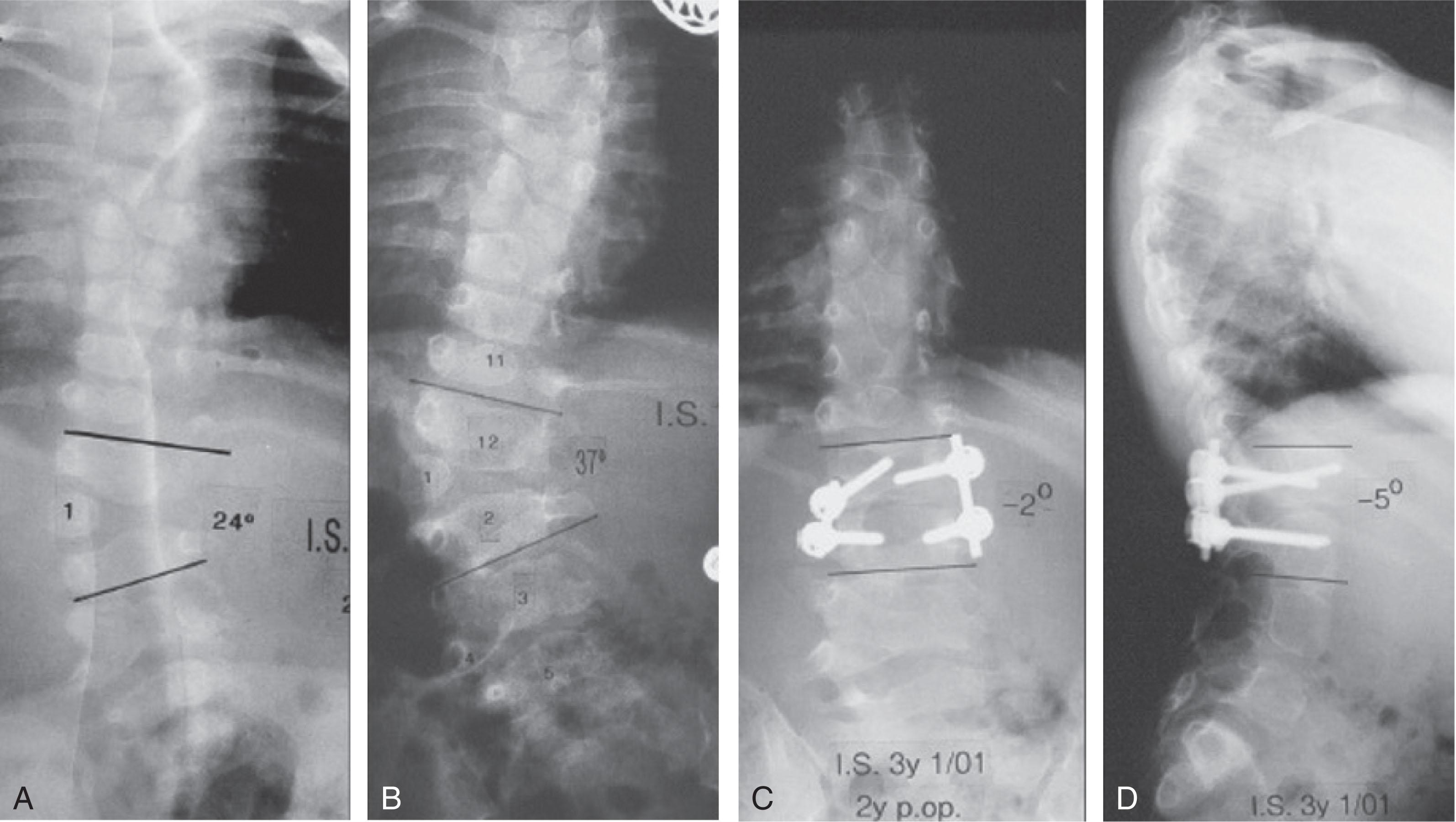 Fig. 22.2, Posteroanterior and lateral x-rays of a hemivertebra causing rapidly progressing deformity in a 3-month-old (A and B). This was treated with hemivertebrectomy and short segment fusion at age 1 year. Excellent correction was attained and is demonstrated here 2 years postoperatively (C and D).