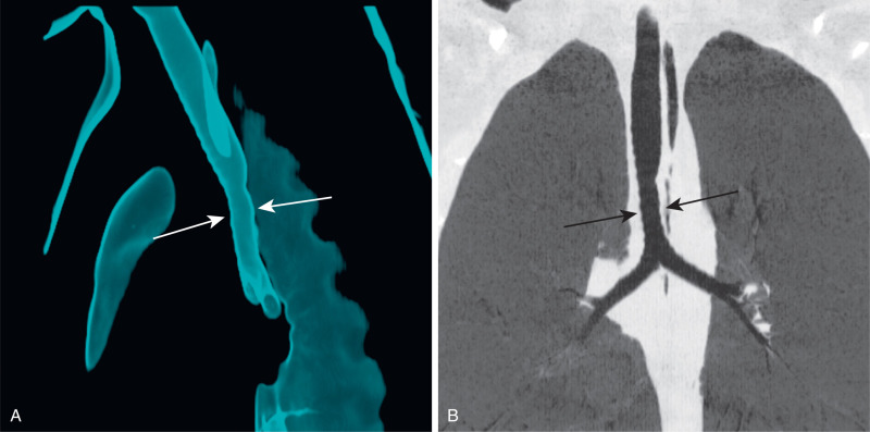 FIGURE 8.2, Congenital tracheal stenosis. External three-dimensional rendering (A) and coronal minimum intensity projection (B) of the trachea demonstrate smooth stenosis of the lower trachea (arrows) .