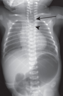 FIGURE 8.4, Congenital tracheoesophageal fistula. Frontal chest radiograph in a neonate with duodenal atresia and tracheoesophageal fistula (TEF). There are a mildly dilated, air-filled proximal esophagus (arrow) and T3 hemivertebra (arrowhead) . Findings are among the VACTERL complex (vertebral defects, imperforate anus, cardiac anomalies, TEF, and renal and limb anomalies). There is a double-bubble sign in the upper abdomen, indicating duodenal atresia.