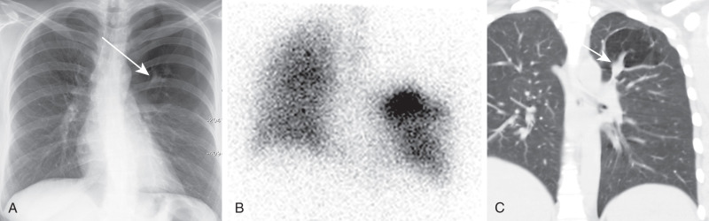 FIGURE 8.7, Bronchial atresia. A , Posteroanterior chest radiograph shows a hyperlucent left upper lobe with subtle rightward mediastinal shift. A left perihilar branching, tubular-shaped opacity (arrow) represents mucoid impaction distal to the atresia. B, Anterior projection ventilation scintigraphic image from a Tc-99m DTPA (technetium-99m-diethylene-triamine-pentaacetate) examination in the same patient shows lack of radiotracer distribution to the hyperlucent left upper lobe. C, Coronal computed tomography scan in a different patient shows a dilated mucus-filled bronchus (arrow) with distal hyperlucency caused by air trapping in the apicoposterior segment.