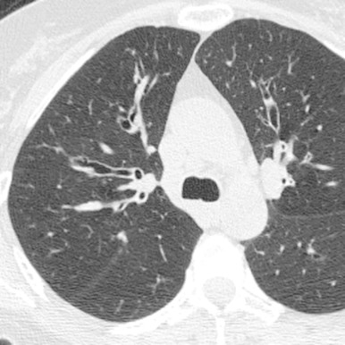 FIGURE 8.8, Williams-Campbell syndrome. Axial computed tomography scan demonstrates central cylindrical bronchiectasis and mild bronchial wall thickening affecting the fourth- through sixth-order bronchi. The trachea, distal bronchi, and bronchioles are of normal caliber.