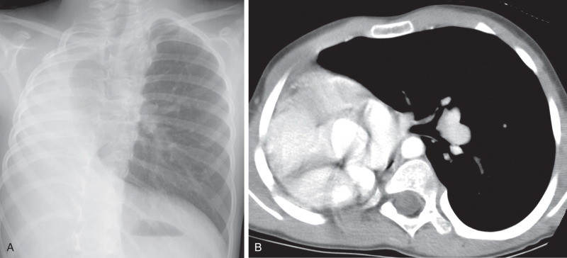 FIGURE 8.9, Pulmonary agenesis. A, Posteroanterior chest radiograph shows complete absence of the right lung, pronounced rightward mediastinal shift, and compensatory left lung hyperinflation. B, Axial contrast-enhanced chest computed tomography scan shows complete absence of pulmonary tissue, bronchi, and pulmonary vessels in the right hemithorax consistent with pulmonary agenesis.