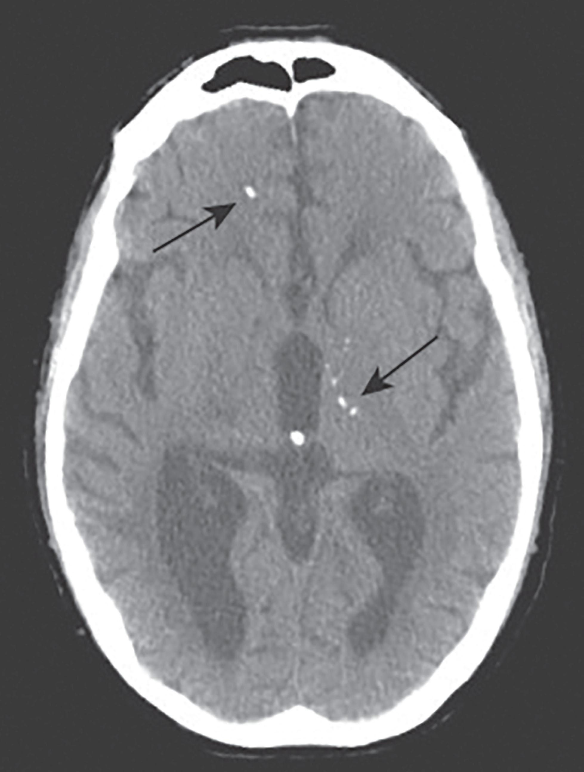 Fig. 35.1, Scattered intracranial calcifications in the right frontal cortex and left thalamic area with ventriculomegaly observed in congenital toxoplasmosis.