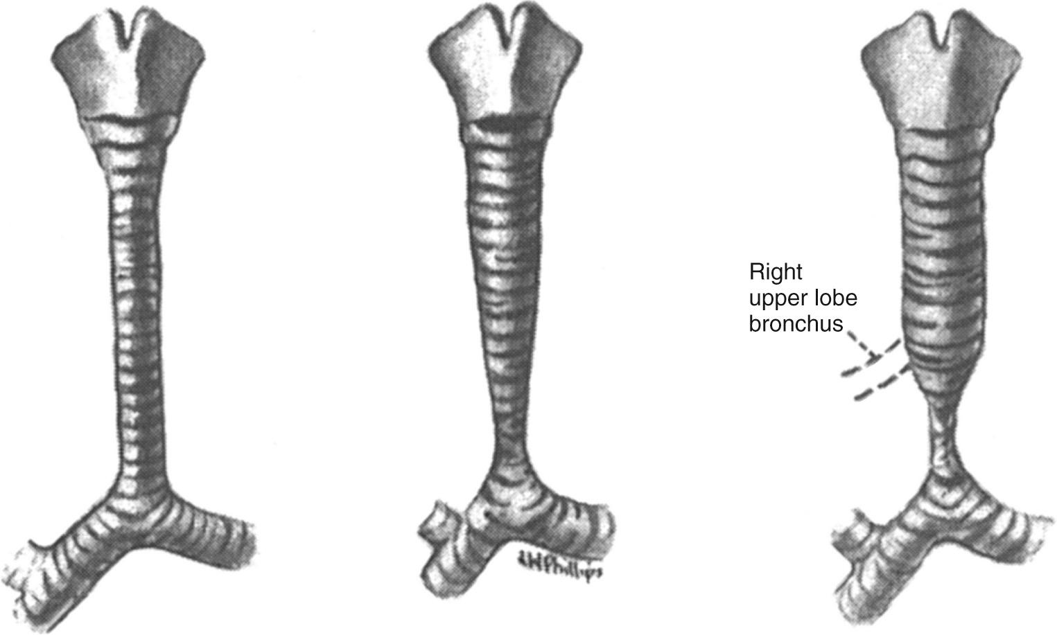 FIGURE 112-1, The three morphologic variants of congenital stenosis of the trachea. Left, Generalized hypoplasia; center, funnel-like stenosis; right, segmental stenosis. The occurrence of an anomalous right upper lobe bronchus (or tracheal right upper lobe) (right) is most common in the segmental form.