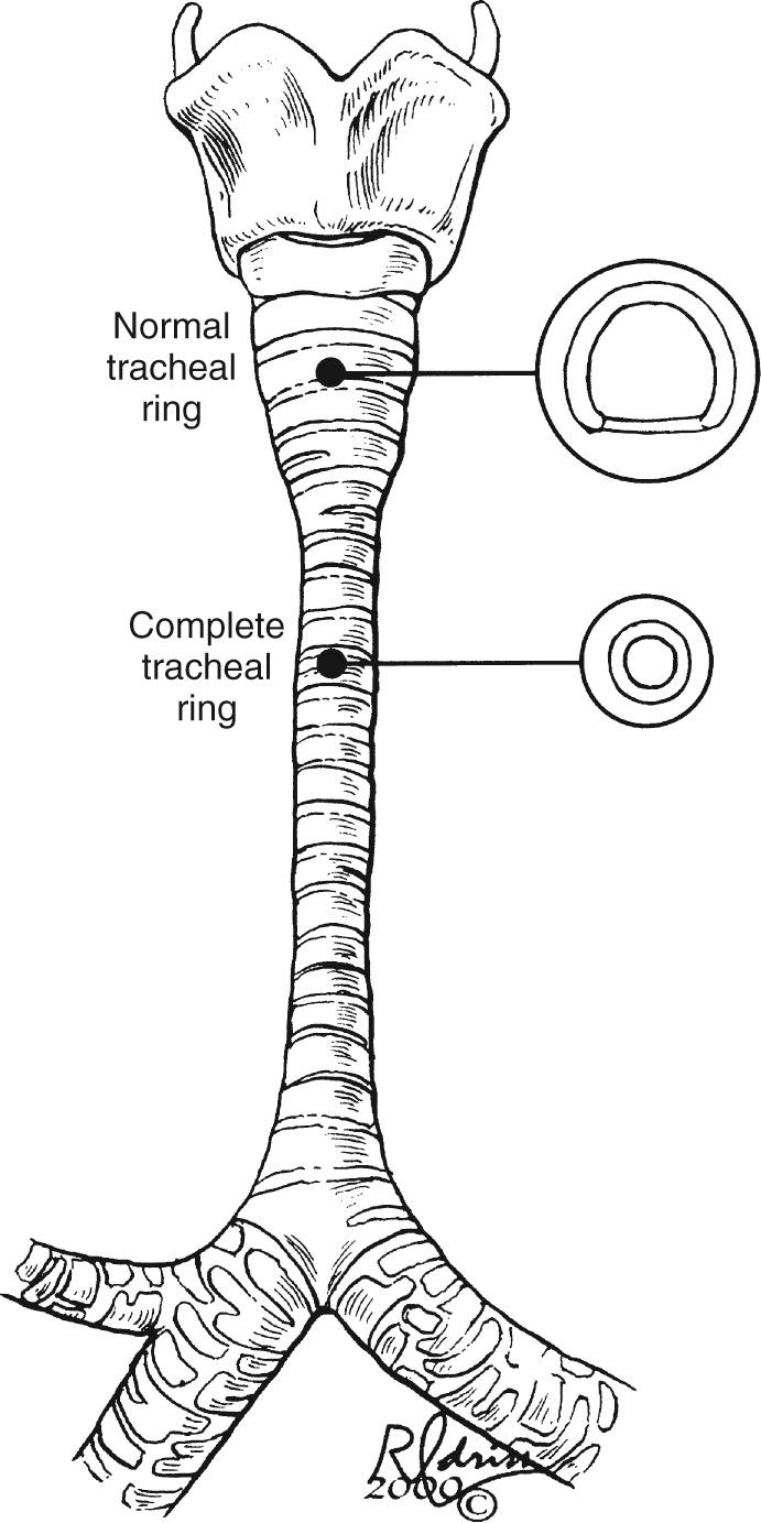 FIGURE 112-2, The trachea of an infant with long-segment tracheal stenosis secondary to complete tracheal rings. There are three normal tracheal rings immediately below the cricoid. The upper cutaway shows a normal tracheal ring with the anterior cartilage and flat posterior membranous trachea. This is followed by 18 complete tracheal rings that progress almost to the carina, one of which, shown in the lower cutaway, is a complete cartilage ring with a substantially reduced tracheal lumen. The tracheal lumen in some of these infants is as small as 1.5 to 2 mm.