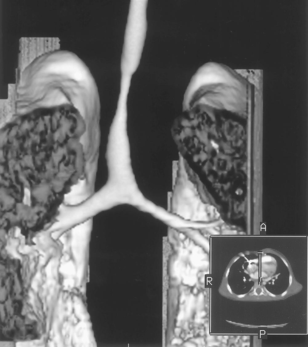 FIGURE 112-3, Computed tomography (CT) (inset) with three-dimensional reconstruction reveals a significant tracheal stenosis in the midportion of this child's trachea. The pathology at the time of surgery was essentially identical to the pathology indicated by the CT scan. A, Anterior; P, posterior; R, right.