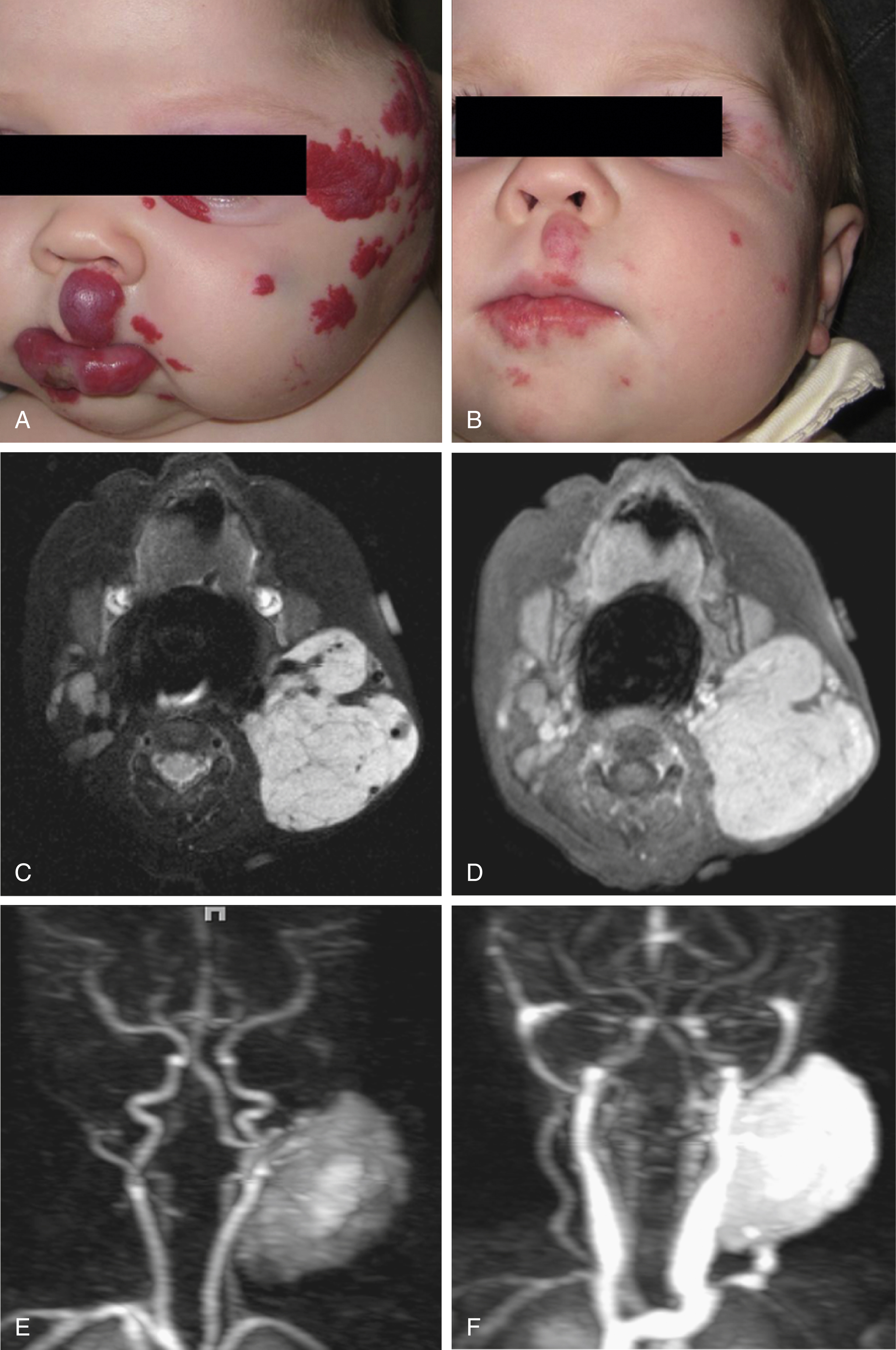 Fig. 16.2, (A) A 10-week-old infant girl with multiple segmental facial red hemangiomas with ulceration and swelling with partial overlapping of left eye affecting vision. (B) After 9 months on propranolol. Note the degree of lesion involution. (C) Magnetic resonance imaging of 6-month-old girl with palpable soft mass in left lateral neck, an infantile hemangioma (IH). Axial T2-weighted image with fat saturation demonstrates well-defined hyperintense soft tissue mass in left side of the neck, with few internal serpiginous flow voids. (D) Same patient as in (C); postcontrast T1-weighted image with fat saturation demonstrates avid homogenous internal contrast enhancement of the solid vascular mass. (E) Same patient as in (C); time-resolved dynamic contrast-enhanced magnetic resonance angiography in arterial phase demonstrates that avid homogenous enhancement of IH starts in arterial phase (note that only arteries are enhanced, no veins visualized) from a feeding artery taking off from left external carotid artery. Serpiginous flow voids noted in (C) were demonstrated to represent feeding arteries and draining veins of the IH. Note draining vein into left subclavian/internal jugular junction (F).