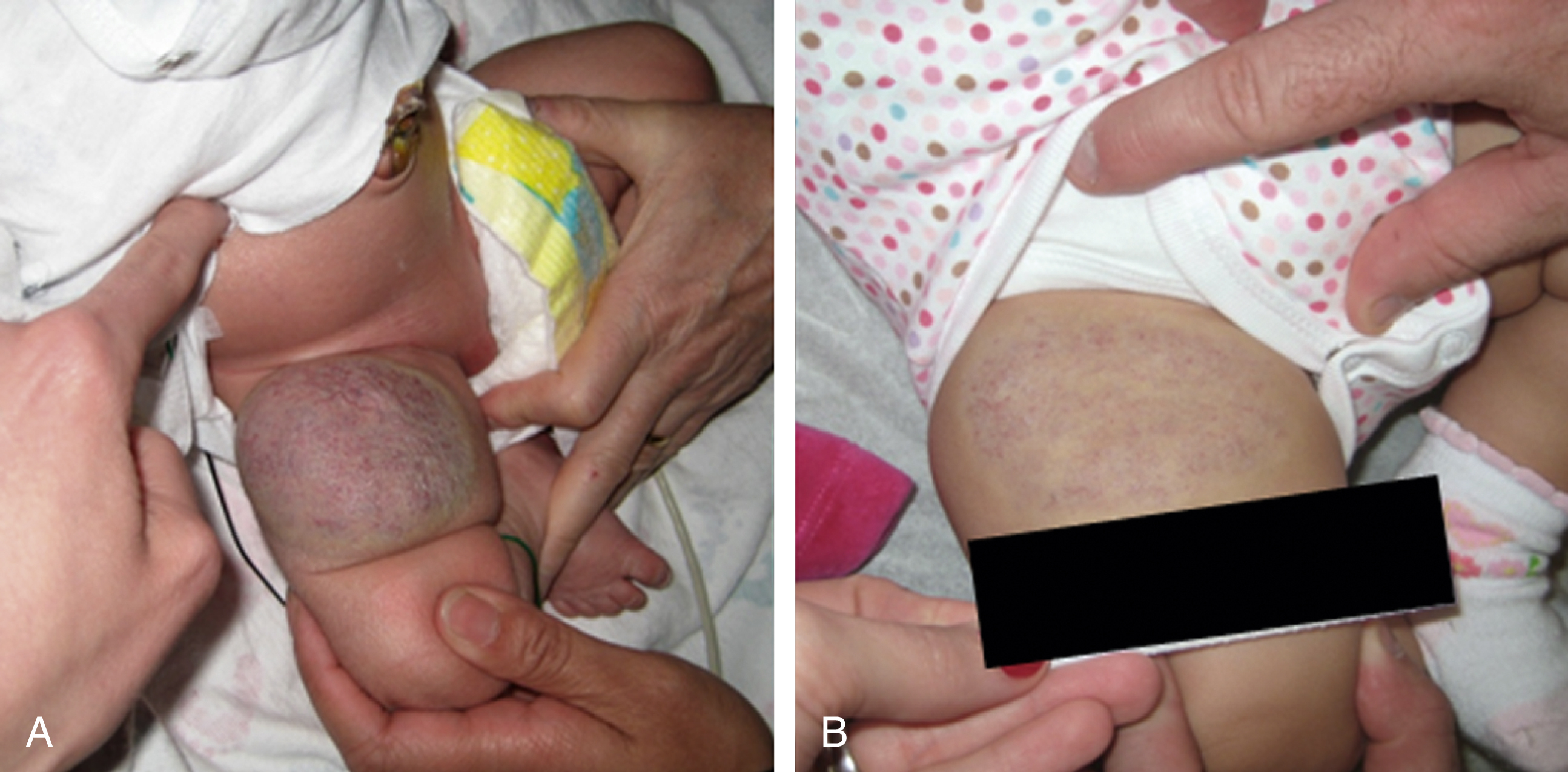 Fig. 16.3, (A) Newborn with round purple mass on right thigh with typical telangiectasia of skin and peripheral pallor consistent with a congenital hemangioma. (B) Same patient at 5 months of age with resolution consistent with a rapidly involuting congenital hemangioma (RICH).