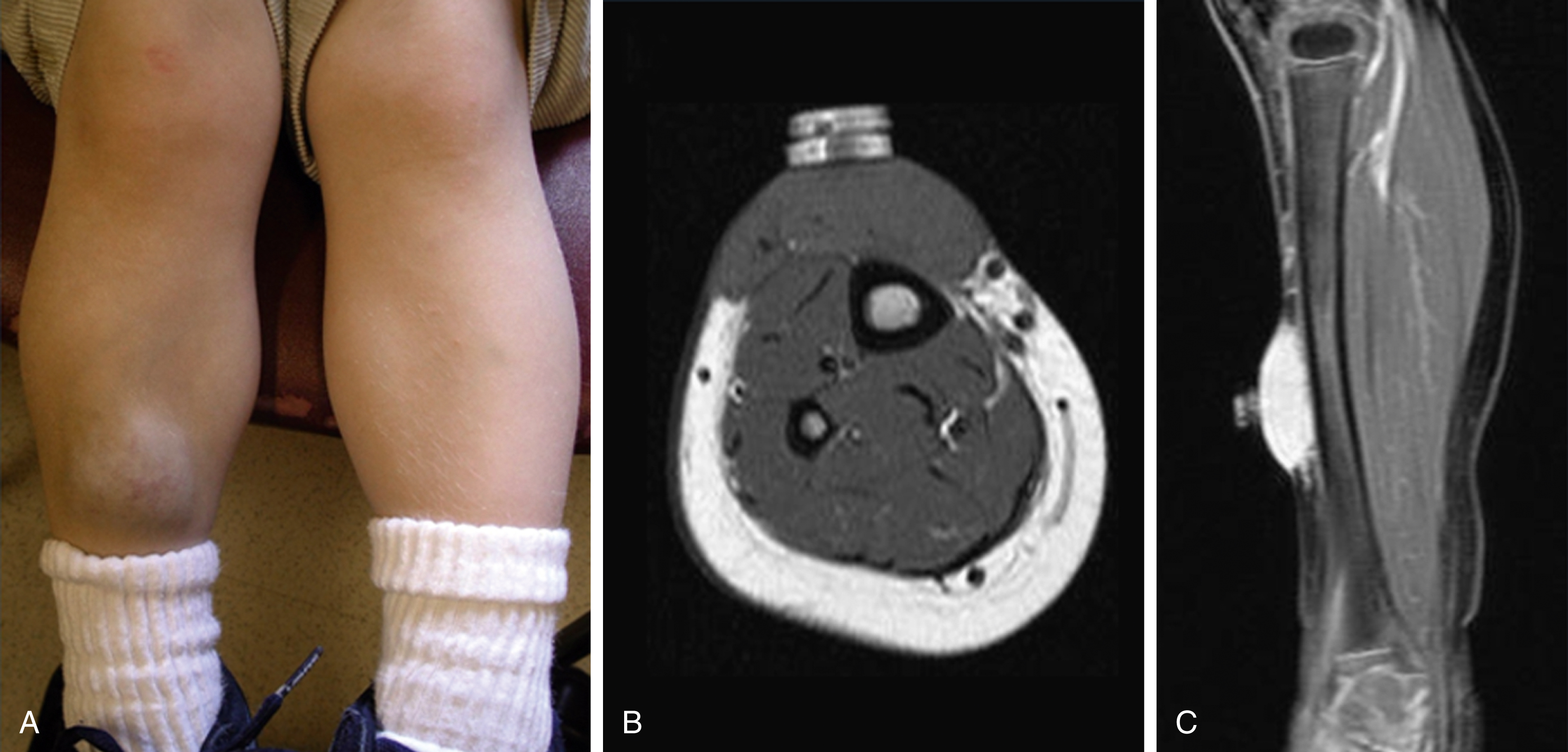 Fig. 16.4, (A) A 4-year-old boy had a raised round lesion on right shin since birth, without regression with coarse purple telangiectasia on overlying skin. (B) Axial T1-weighted image without fat saturation clearly demonstrates infiltration of skin typical of congenital hemangiomas. (C) Axial postcontrast T1-weighted image with fat saturation demonstrates avidly enhancing solid vascular mass with skin infiltration. This constellation of imaging findings together with patient’s age and absence of regression since presentation at birth confirms diagnosis of noninvoluting congenital hemangioma (NICH).