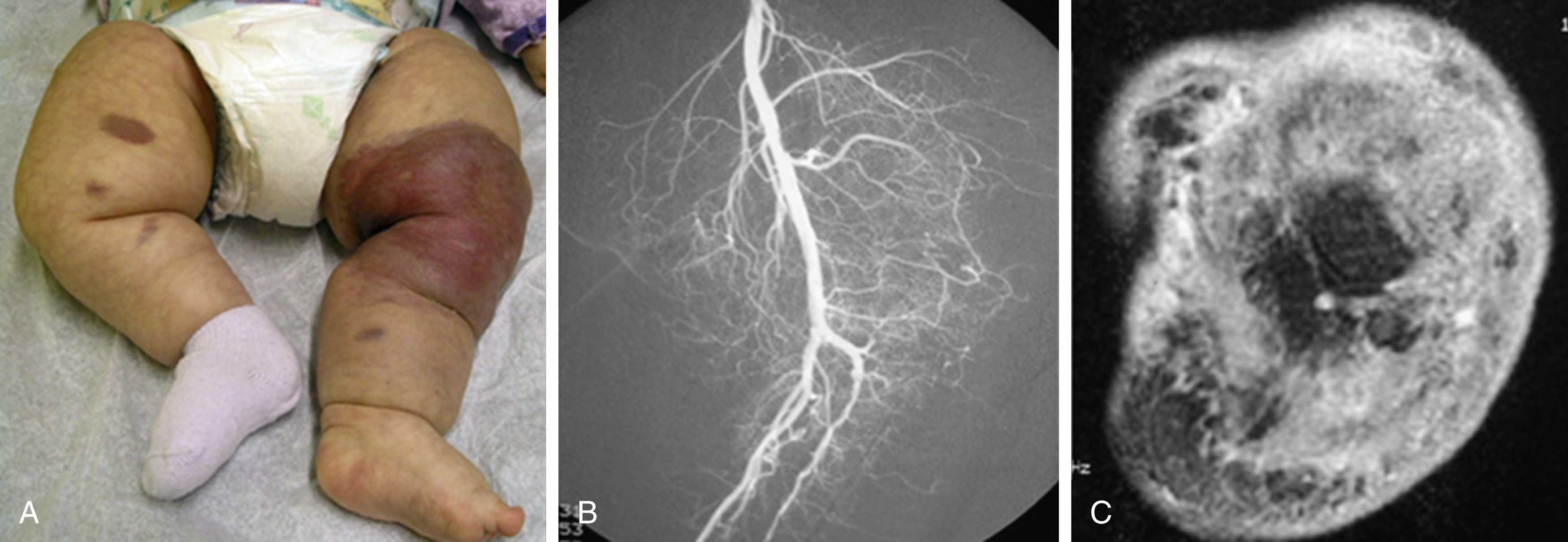 Fig. 16.5, (A) An 11-month-old girl was born with an ill-defined purple, firm, indurated lesion overlying left knee region. Vascular anomaly was notable for being extremely painful and limiting movement of left lower extremity. (B) Lateral view of arteriogram of left knee, demonstrating enlarged feeders off lower superficial femoral and popliteal arteries filling the hypervascular mass. (C) Axial postcontrast T1-weighted image with fat saturation demonstrates infiltration of skin, subcutaneous fat, muscle groups, and cortex of bone by this enhancing infiltrative vascular anomaly. Infiltrative and aggressive nature of this painful solid mass in a young child confirms diagnosis of kaposiform hemangioendothelioma.