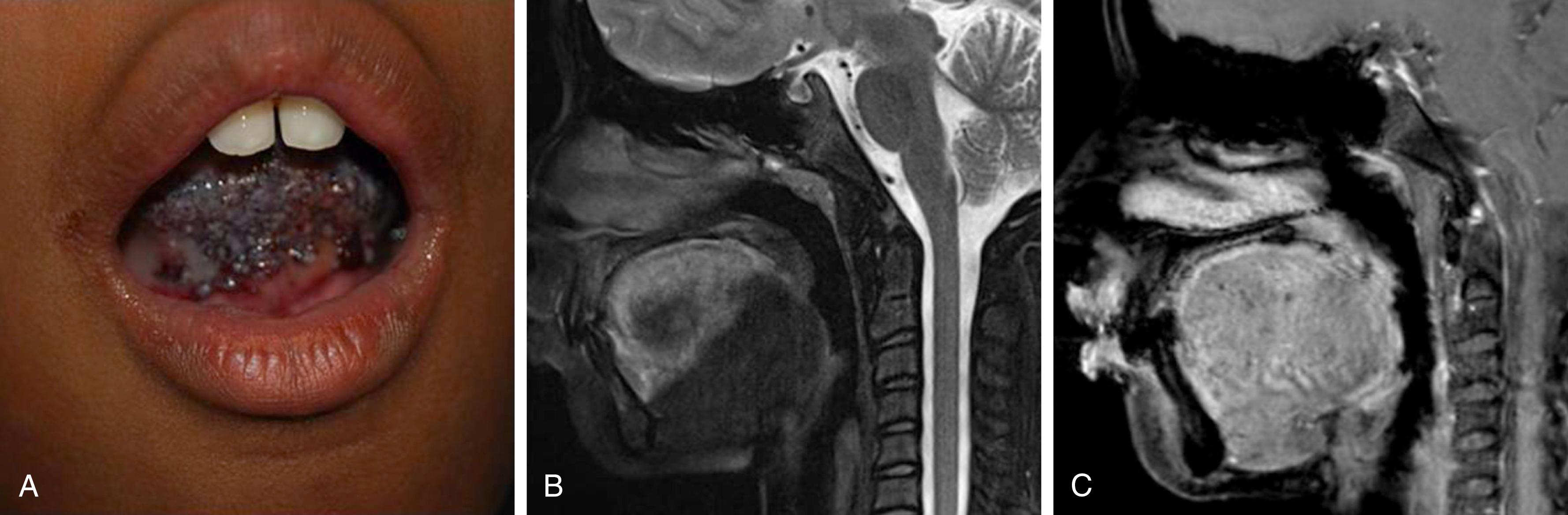 Figure 172.1, ( A ) An 11-year-old female with LVM of the tongue, status post-tongue reduction surgery and prior laser treatment. Recurrence of numerous small blue-black cystic lesions on her tongue. They weep clear lymphatic and bloody fluid. ( B – C ) Sagittal T2-weighted image of the tongue shows increased T2 signal in the intrinsic tongue muscles, which are mildly enhanced in the contrast-enhanced T1-weighted sagittal image ( C ). Magnetic resonance imaging (MRI) is helpful for identifying the depth of infiltration in this superficial lesion.