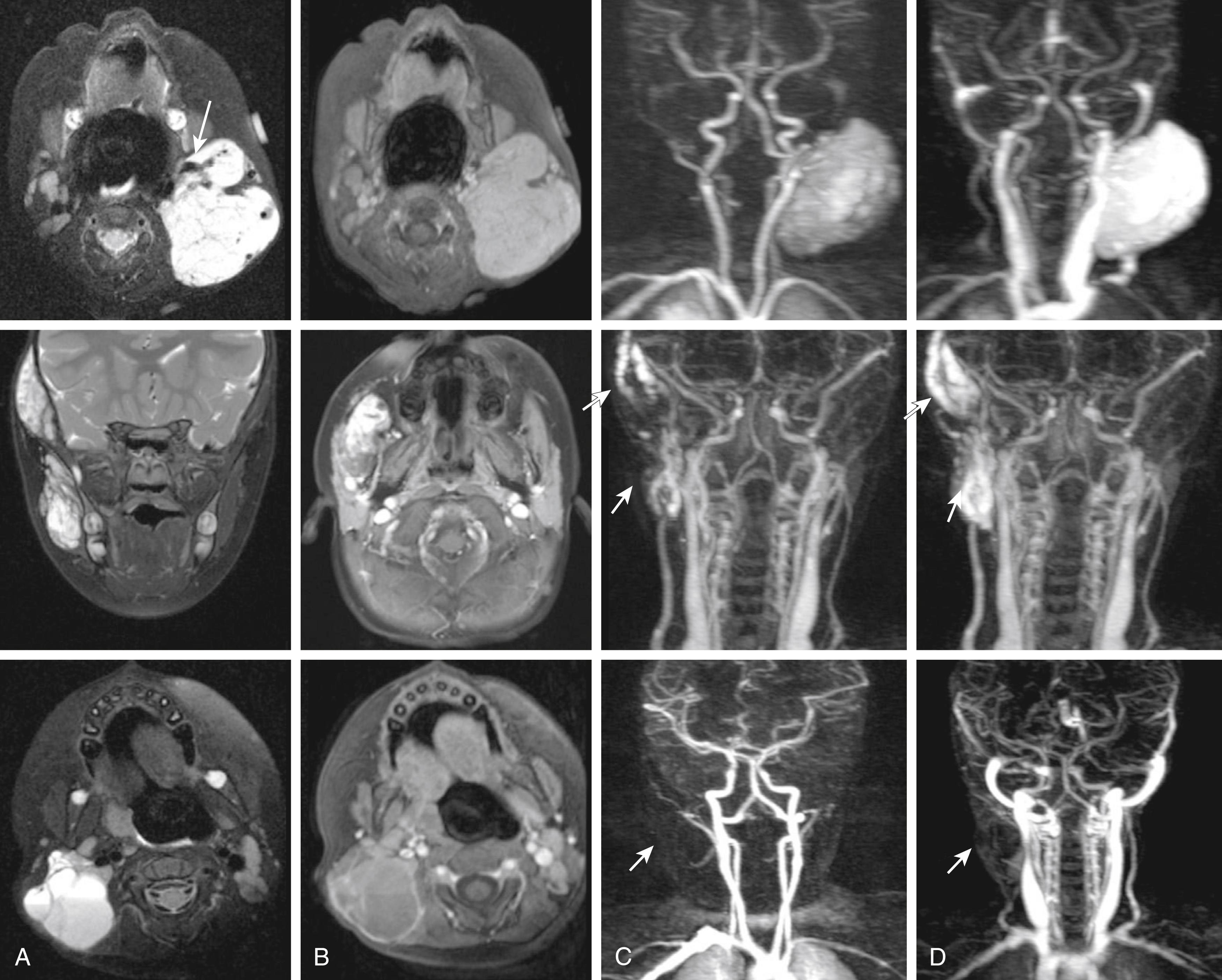 Figure 172.2, Top row: Infantile hemangioma (IH). ( A ) Axial T2-weighted fat-saturated image and ( B ) axial T1-weighted postcontrast fat-saturated image demonstrating a well-demarcated T2 hyperintense mass with clean borders and homogeneous internal enhancement. Note the serpiginous internal flow void (arrow) ( A ) from an arterial feeder. Coronal TWIST demonstrates avid enhancement in the arterial phase ( C ) with a feeder from the external carotid artery and lack of washout during the venous phase ( D ). Note the venous drainage to the left subclavian vein. Middle row: Venous malformation (VM). ( A ) coronal T2-weighted fat-saturated image demonstrates a predominantly T2 hyperintense mass infiltrating the right masticator and temporalis muscle. Note multiple small round T2 dark foci, representing phleboliths. ( B ) Axial T1-weighted postcontrast fat-saturated image demonstrates strong but somewhat heterogeneous internal enhancement. ( C, D ) Coronal TWIST demonstrates progressively increasing enhancement during the venous phase (arrows) . There was no enhancement in the arterial phase (not shown). Bottom row: Lymphatic malformations (LMs). ( A ) Axial T2-weighted fat-saturated image demonstrates a lobular multicystic mass with a fluid–fluid level in the soft tissues of the right lower neck. Axial T1-weighted postcontrast fat-saturated image ( B ) demonstrates enhancement of the cyst wall only without any internal enhancement. Lack of internal enhancement distinguishes LMs from VMs. The layering bright T1 signal is likely due to internal hemorrhage. Coronal TWIST did not demonstrate enhancement in the arterial or in the venous phase (arrows) ( C , D ).