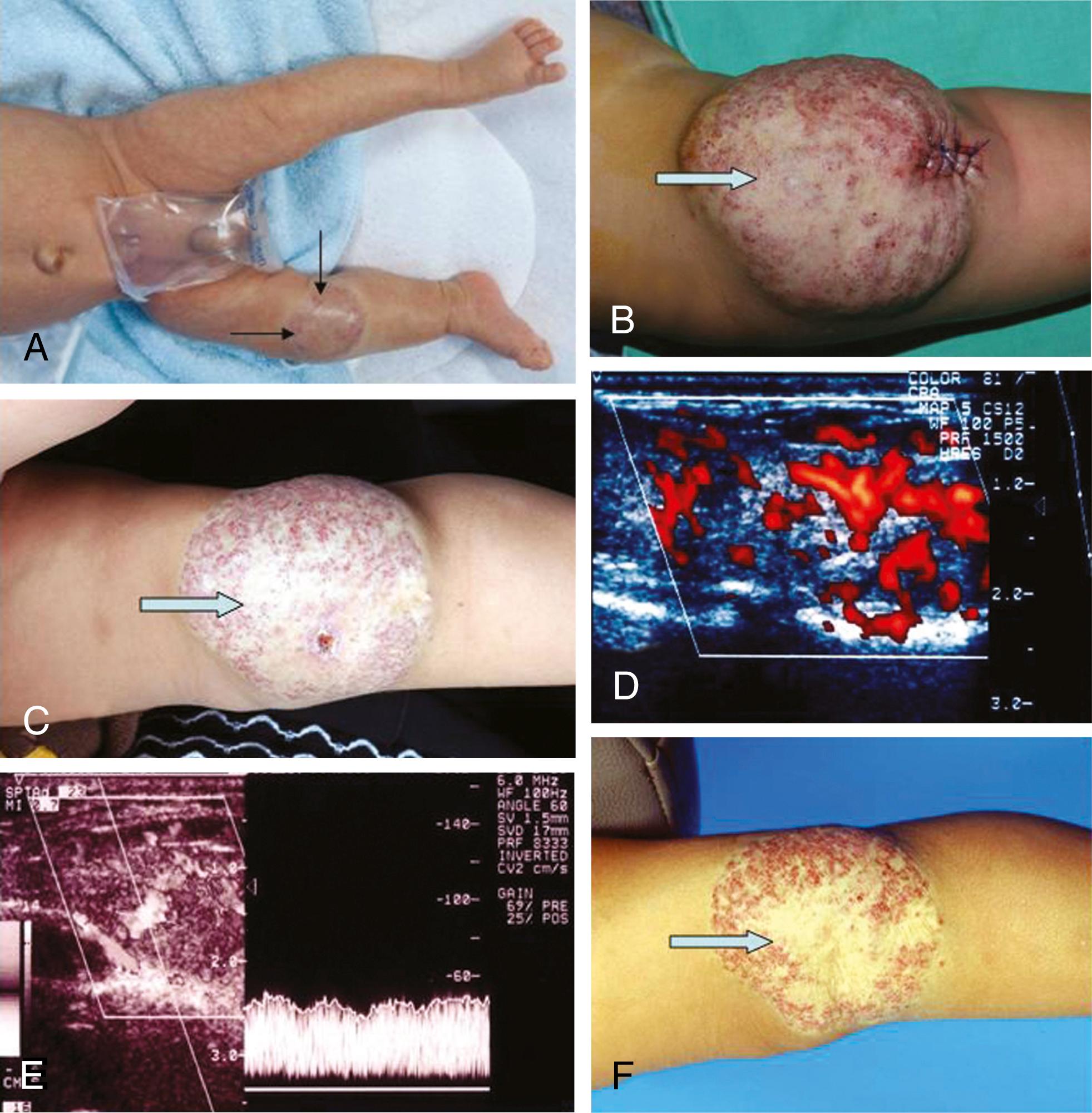 Figure 170.1, Hemangioma and Vascular Malformation.