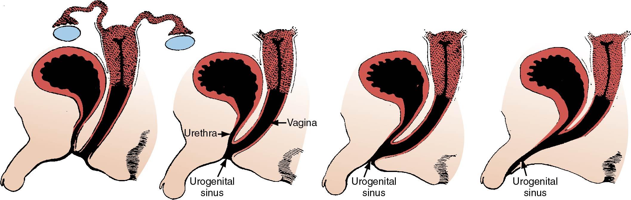 Fig. 11.1, Examples of 46,XX disorders of sexual development induced by prenatal exposure to androgens. Exposure after 12th fetal week leads only to clitoral hypertrophy (left). Exposure at progressively earlier stages of differentiation (from left to right) leads to retention of the urogenital sinus and labioscrotal fusion. If exposure occurs sufficiently early, the labia fuse to form a penile urethra.