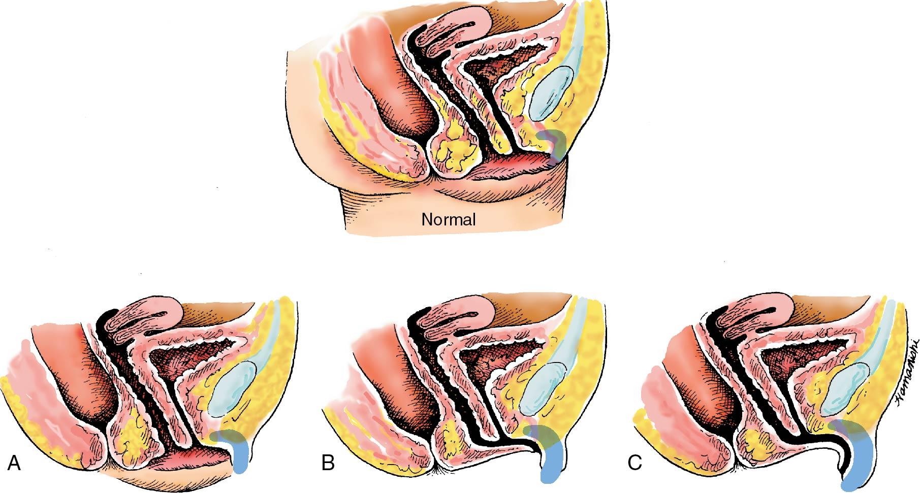 Fig. 11.2, Sagittal views of genital deformities seen in female infants who are masculinized. A, Minimal masculinization with slight enlargement of the clitoris. B, Labial fusion and more marked enlargement of the clitoris. C, Complete labial fusion, enlargement of the clitoris, and formation of a partial penile urethra.