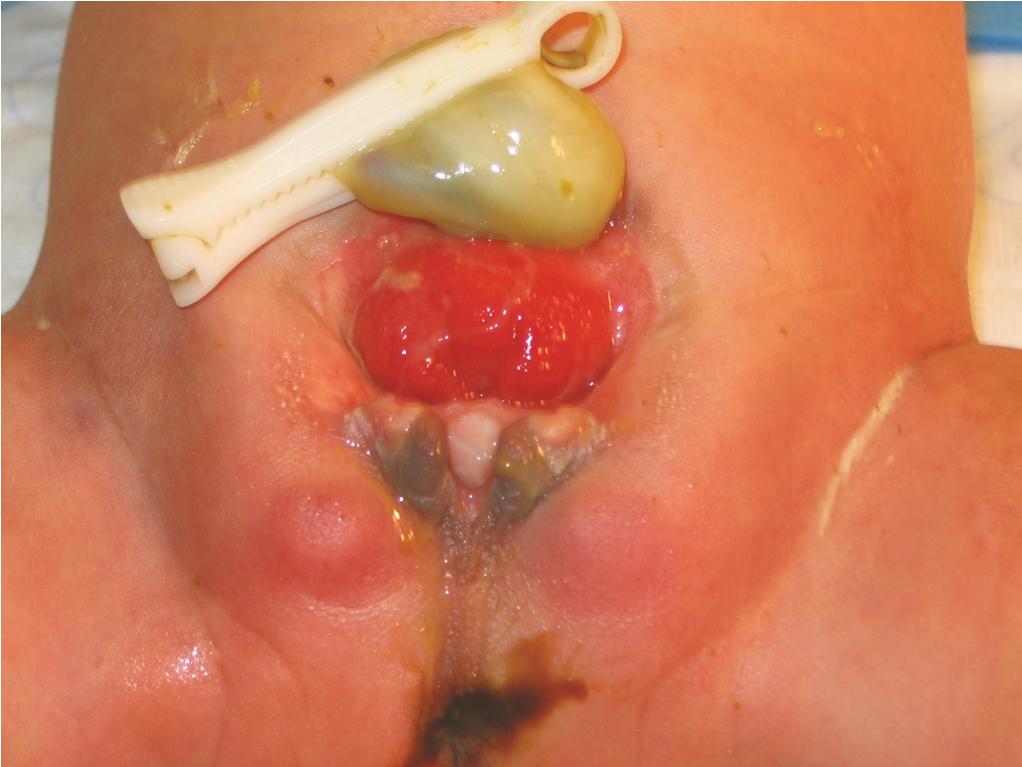 Fig. 11.5, An example of a bifid clitoris in an infant with extrophy of the bladder.