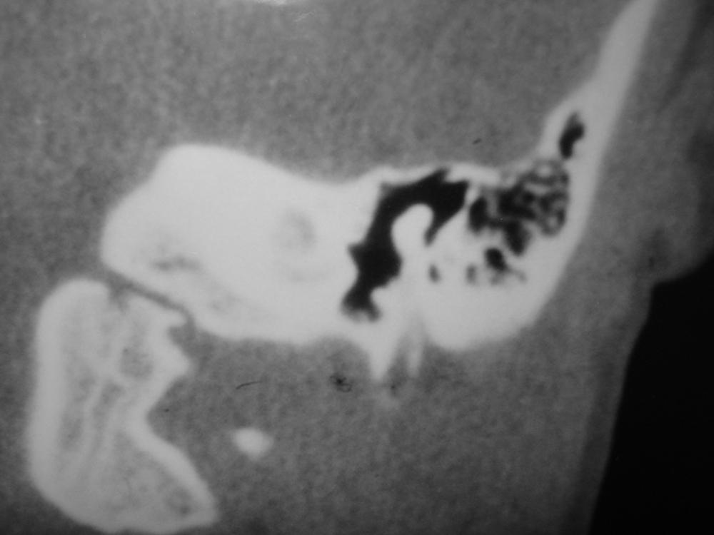 Fig. 208.2, Coronal CT of left temporal bone with congenital aural atresia. Note high tegmen mastoideum, well-pneumatized mastoid and middle ear, and malleus attached to atretic plate.