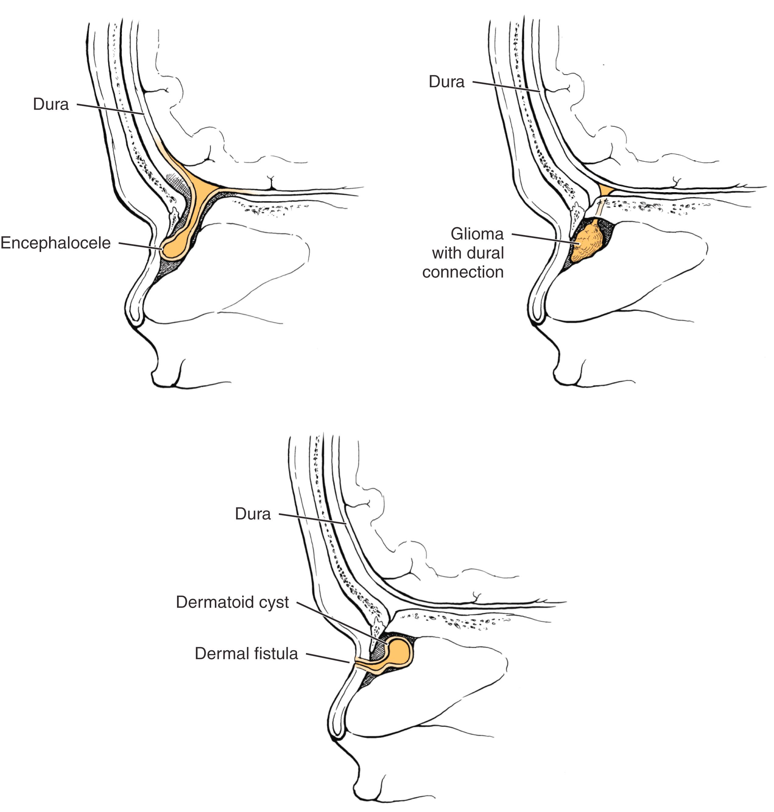 Fig. 5.1, Schematic view of the common midline nasal masses.