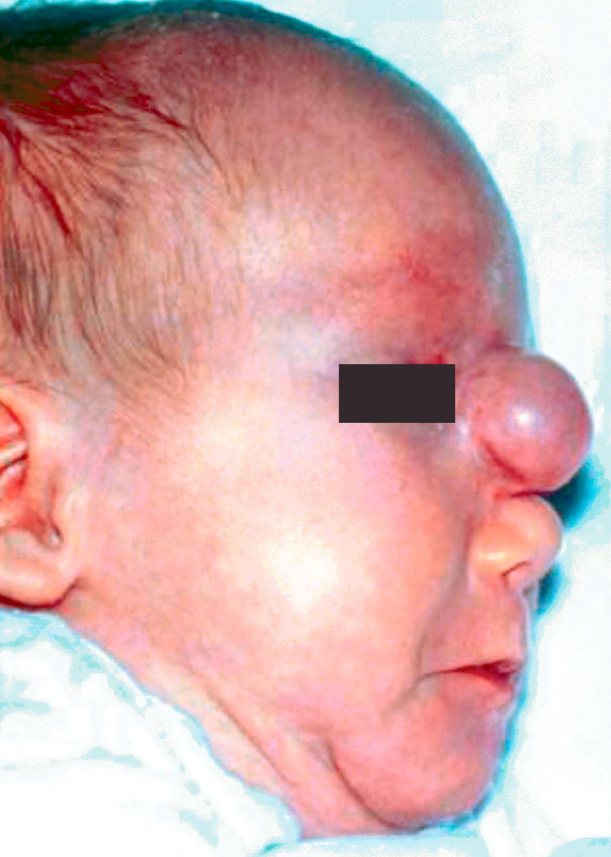 Fig. 5.2, Sincipital encephalocele. A soft bluish compressible mass is protruding from the glabellar region.