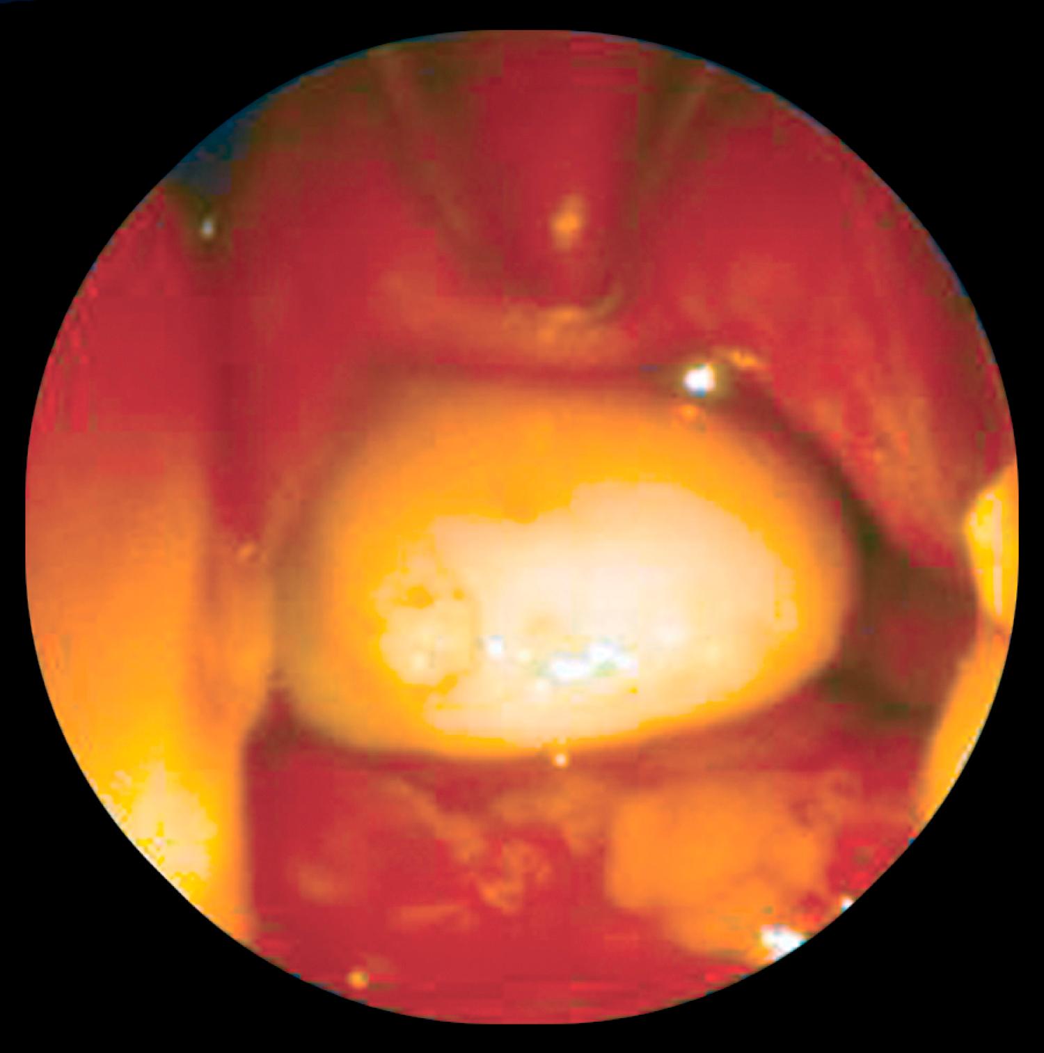 Fig. 5.3, Basal encephalocele seen in the nasopharynx with a 120-degree angled telescope.