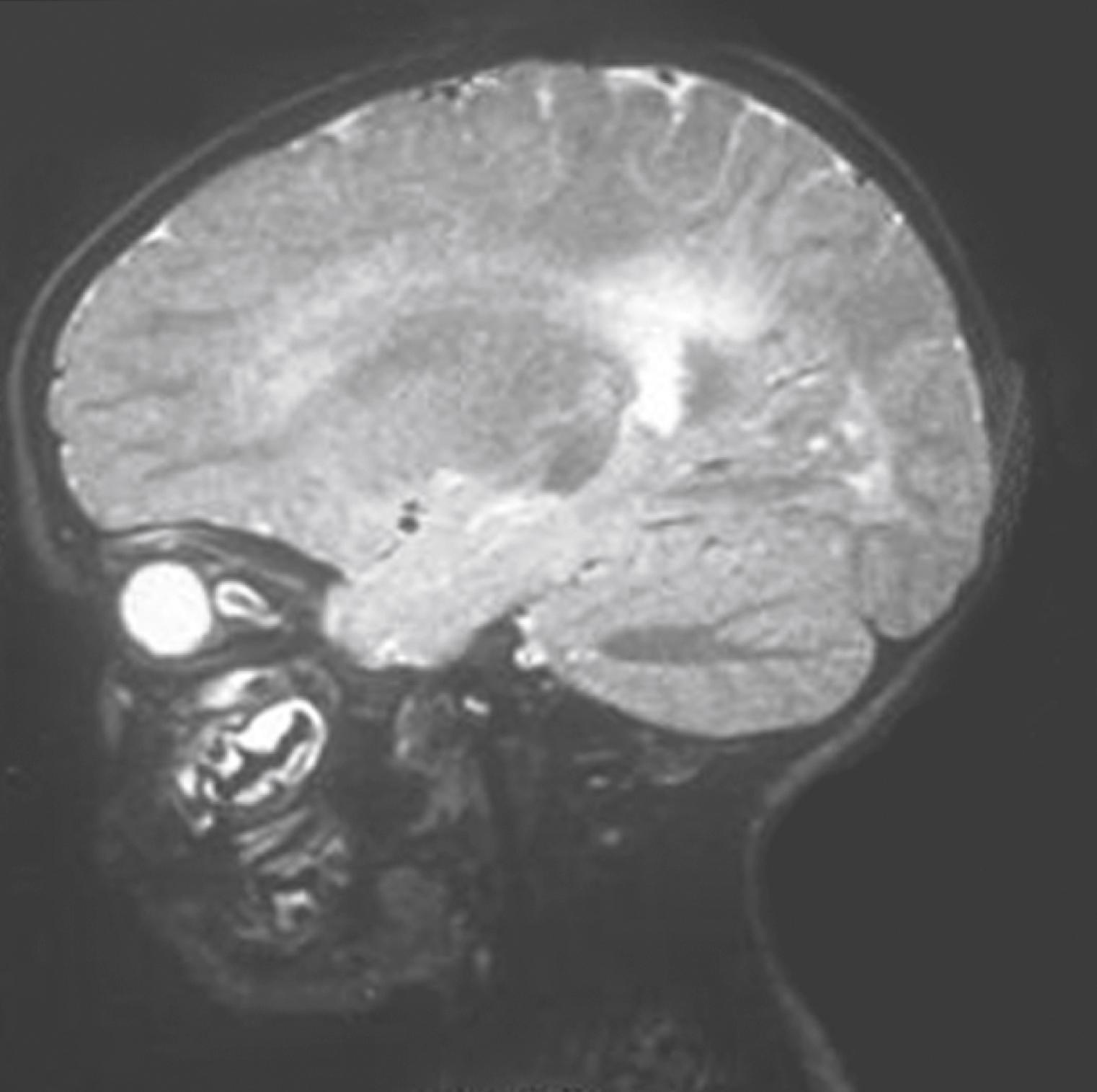 Fig. 5.4, Sagittal magnetic resonance imaging of a basal meningoencephalocele protruding into the nasopharynx.