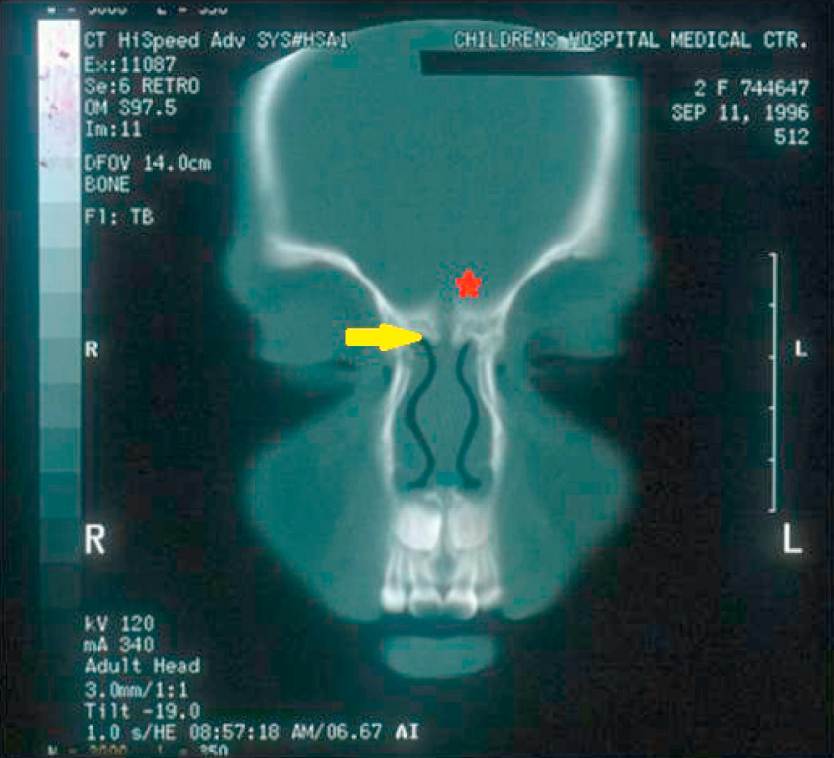 Fig. 5.6, Coronal computed tomography scan showing a bifid crista galli (red star) and an enlarged foramen cecum (yellow arrow).