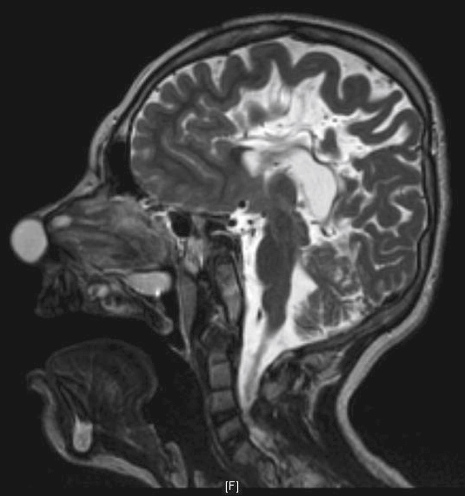 Fig. 5.7, Sagittal magnetic resonance imaging of a nasal dermoid, evident as a region of signal hyperintensity in the anterior nasal septum as a hyperintense lesion.