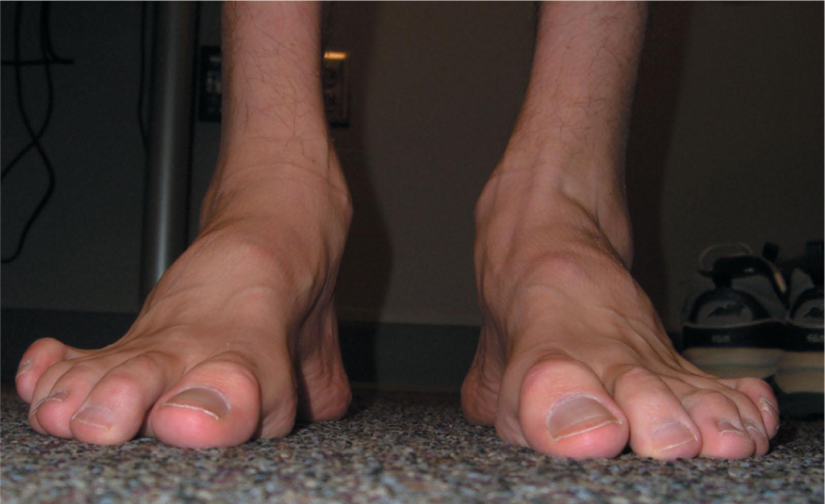 Fig. 19-1, Foot and ankle images of a patient with Charcot-Marie-Tooth disease demonstrating peek-a-boo heel, consistent with hindfoot varus, a plantar-flexed first ray, and clawing of the lesser toes. Note the significant leg musculature wasting.