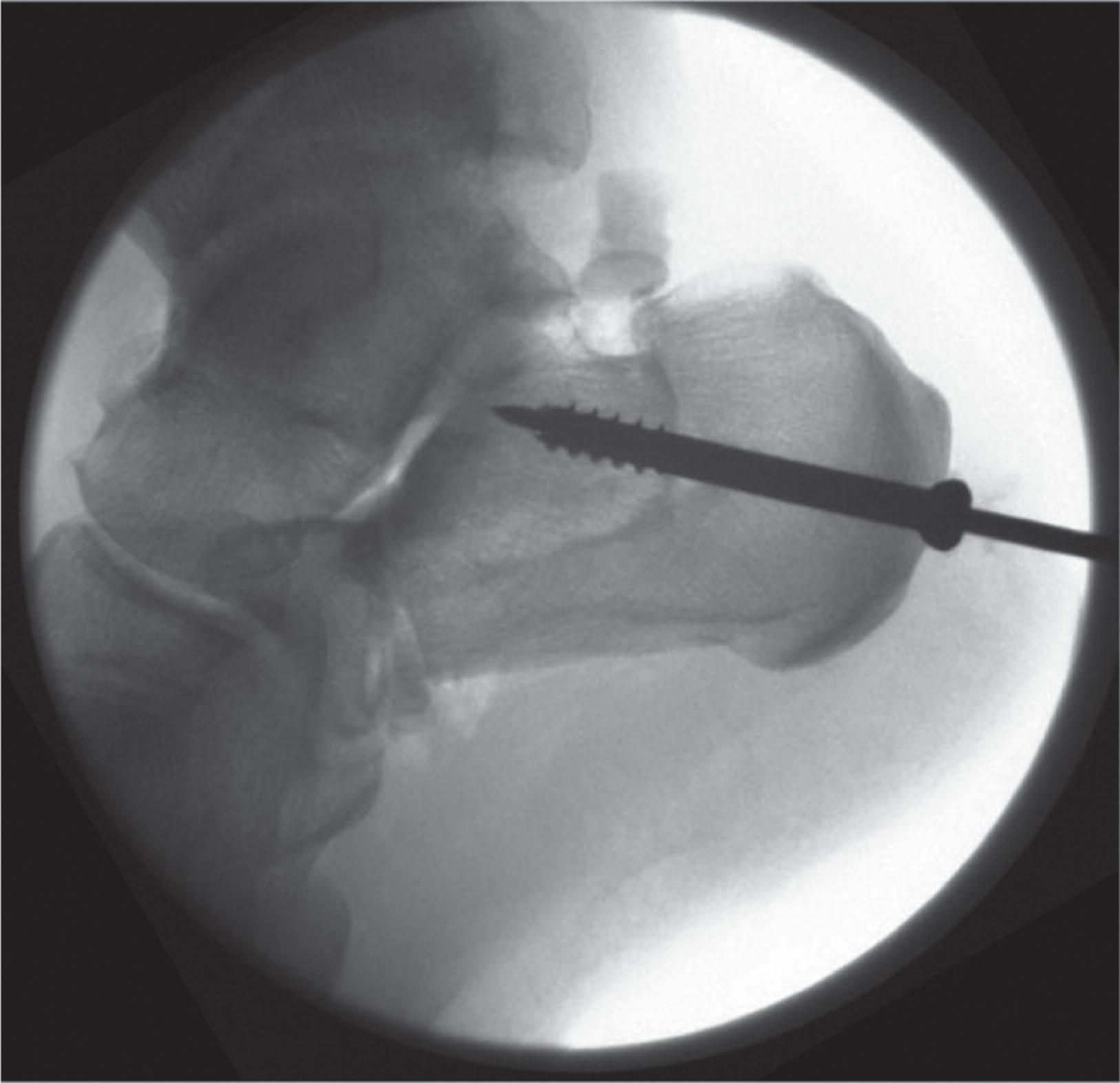 Fig. 19-11, Intraoperative lateral fluoroscopic image demonstrating Z-shaped osteotomy with internal fixation in a patient with cavovarus foot correction surgery.