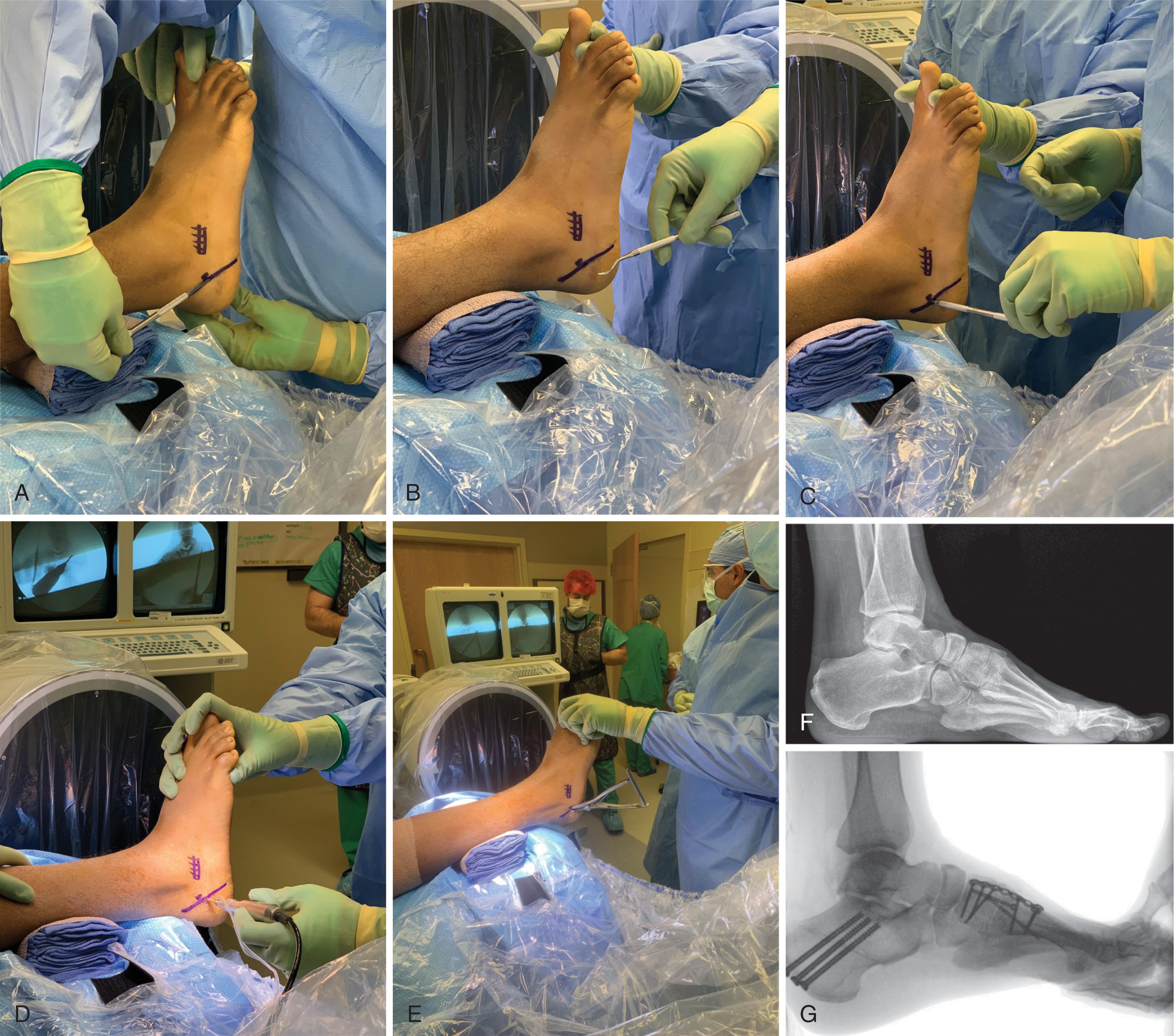 Fig. 19-12, Cavovarus foot from Charcot-Marie-Tooth Disease. A and B , Marking the plane for a minimally invasive (MIS) calcaneal osteotomy. C , Marking the entry point for the MIS burr. D , The burr is passed into the calcaneus and, with a sweeping motion, the calcaneal osteotomy is completed. E , A lamina spreader is used to confirm completion of the osteotomy. F , Lateral radiograph before surgery. G , Intraoperative fluoroscopy images after a cavovarus foot reconstruction. The reconstruction consisted of a MIS lateralizing calcaneal osteotomy, plantar fascia release, peroneus longus to brevis transfer, first ray dorsiflexion osteotomy, and talonavicular joint capsule release.