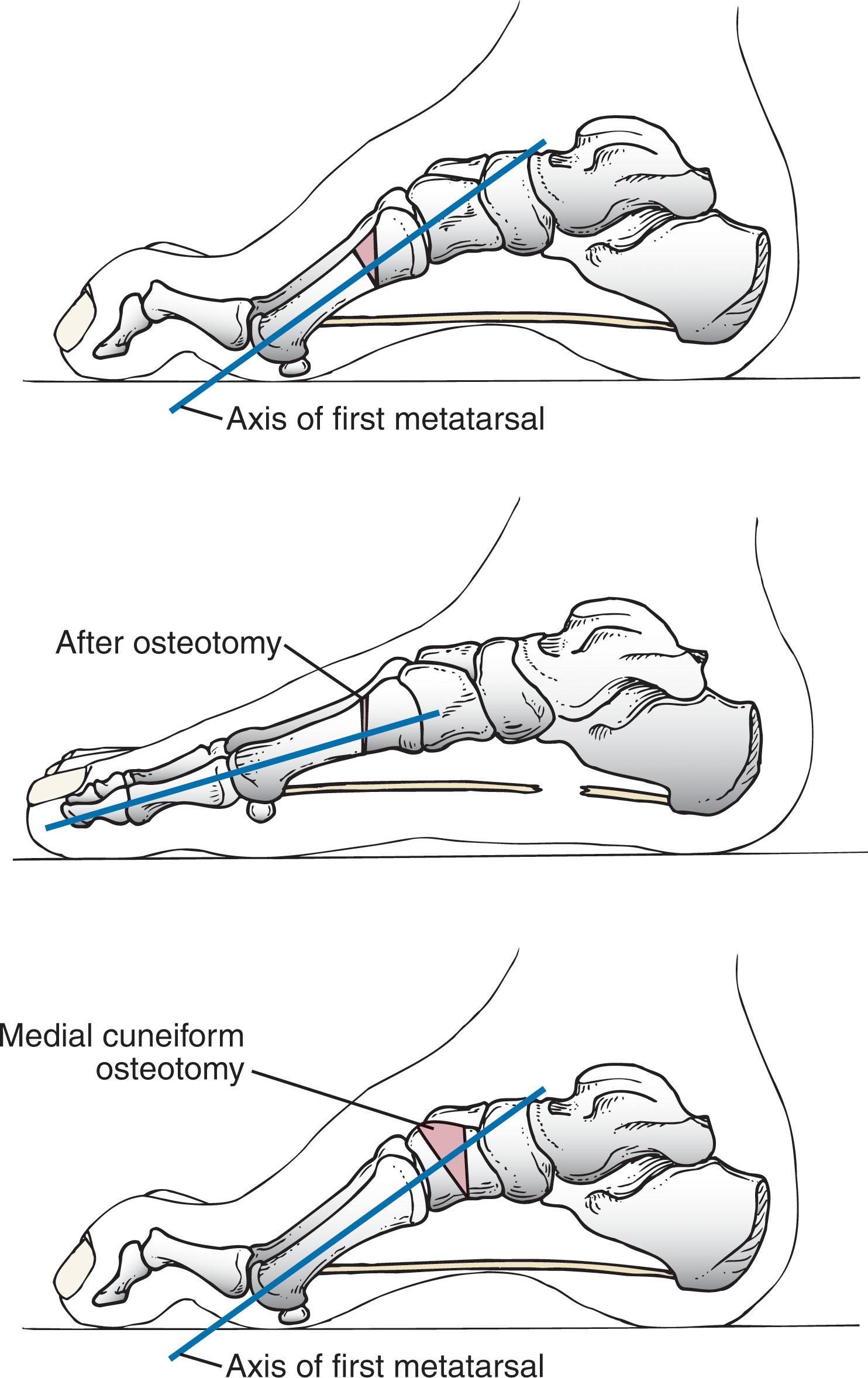 Fig. 19-13, First metatarsal closing-wedge osteotomy is appropriately sized. The surgeon must be careful not to cut through the plantar cortex to help maintain stability. Rigid internal fixation is used.