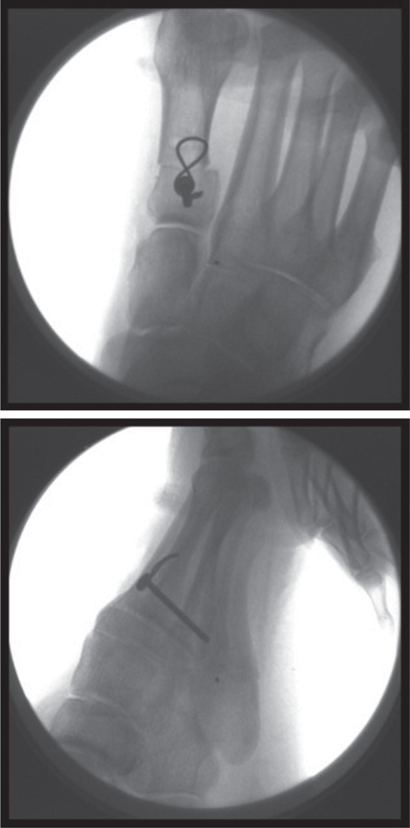 Fig. 19-14, Anteroposterior (top) and lateral (bottom) fluoroscopic images of dorsal closing-wedge osteotomy of the first metatarsal with tension band fixation technique.