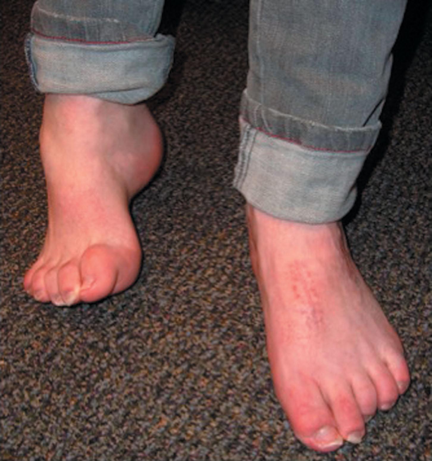 Fig. 19-16, Clinical photograph of a patient who has undergone left cavovarus foot reconstruction with calcaneal and metatarsal osteotomies and posterior tibial tendon transfer for cavovarus foot deformity secondary to Charcot-Marie-Tooth disease. The right foot is untreated so far.