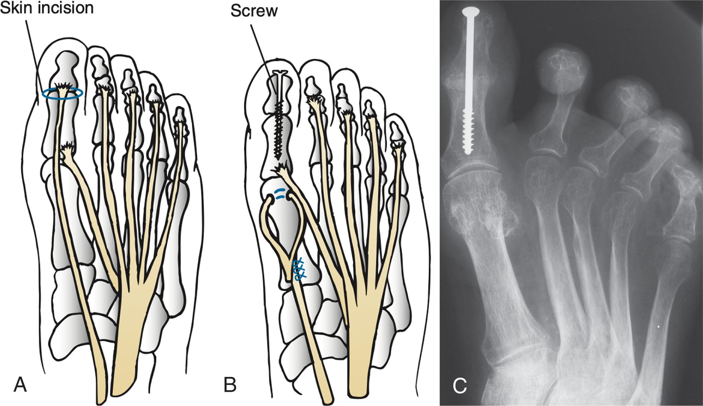 Fig. 19-17, First toe Jones procedure moves pull of extensor hallucis longus (EHL) tendon from the great toe into the neck of the first metatarsal. Interphalangeal (IP) joint arthrodesis of the hallux is performed. A, Incision is made over the first IP joint, the joint surfaces are prepared, and the EHL tendon is released. B, A screw is placed from the tip of the toe across the fusion, and the EHL tendon is transferred to the first metatarsal shaft. C, Radiographs showing successfully fused IP joint. This procedure results in elevation of first metatarsal and thus eliminates the cock-up deformity of the first metatarsophalangeal joint.