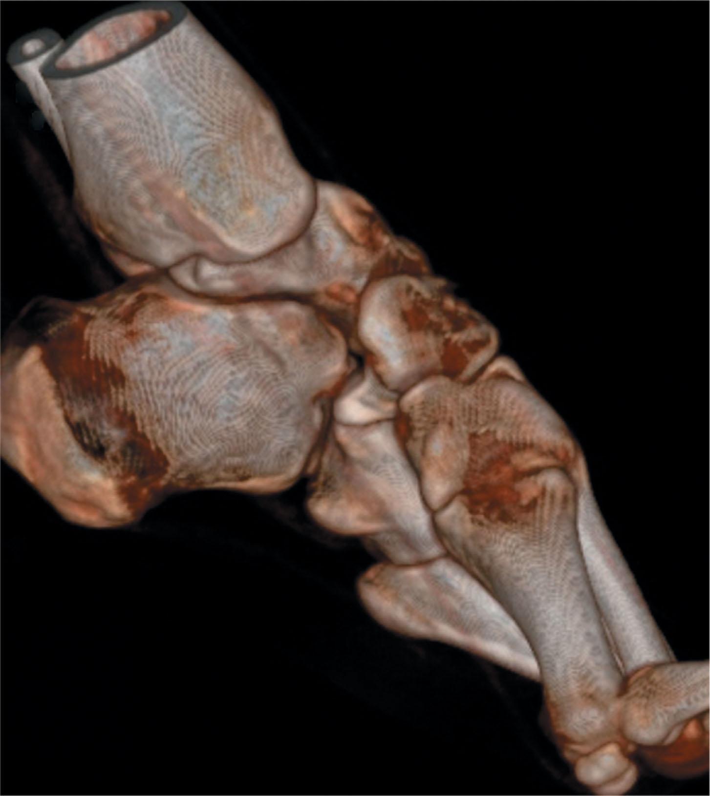 Fig. 19-2, Computer tomography reconstruction of a patient with Charcot-Marie-Tooth disease demonstrating a severely plantar-flexed first ray consistent with overpull of the peroneus longus relative to the tibialis anterior.