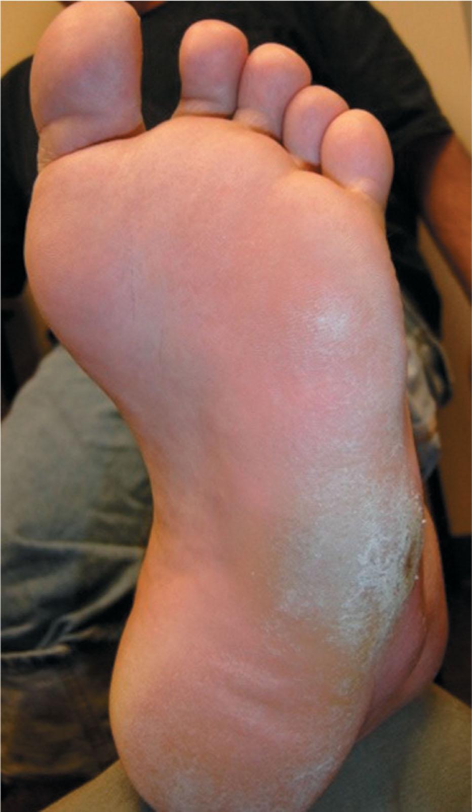 Fig. 19-3, Plantar view of a patient with Charcot-Marie-Tooth disease and associated sensory neuropathy with lateral midfoot ulceration secondary to lack of protective sensation and mechanical overload.