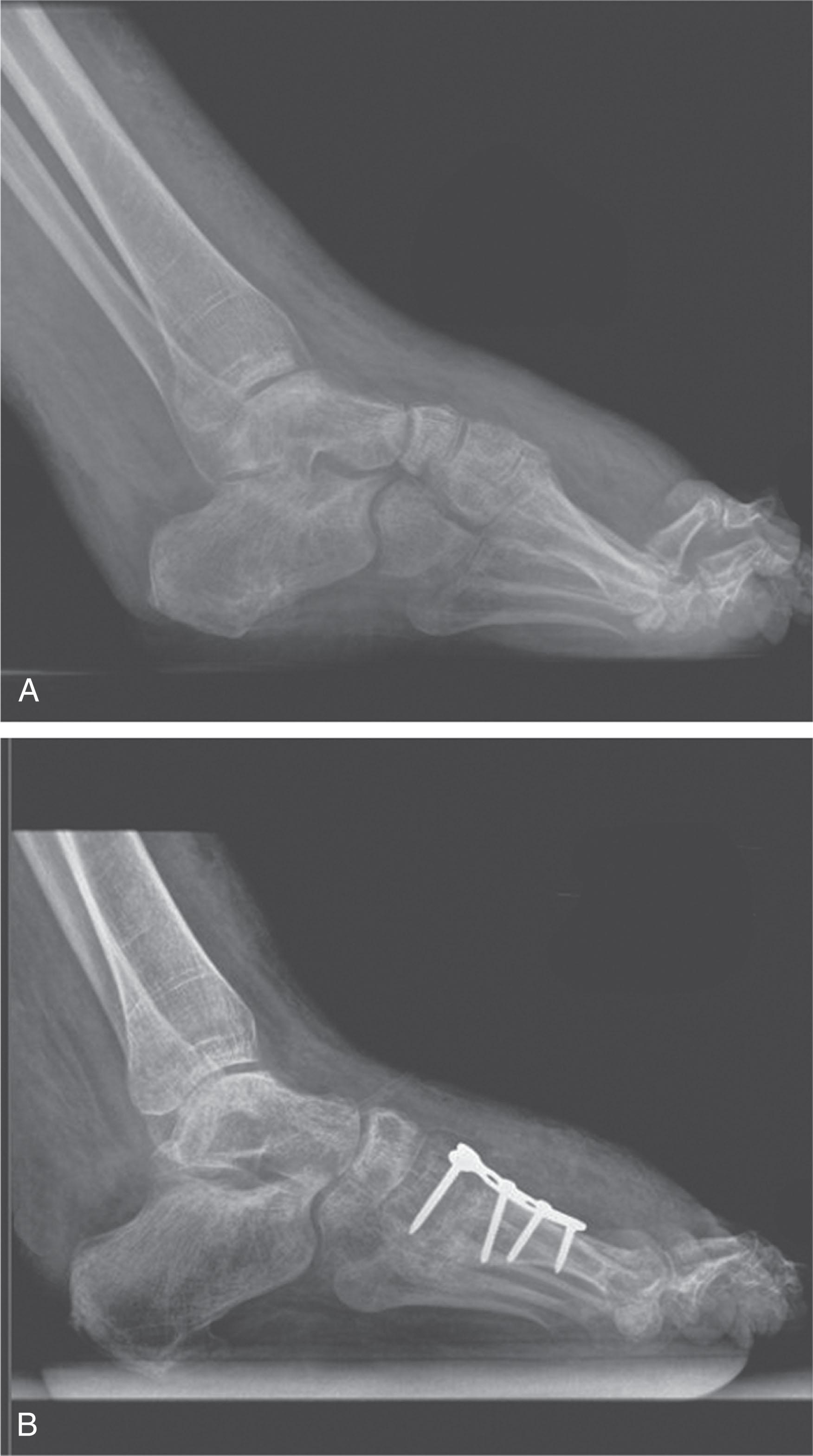 Fig. 19-5, Lateral radiographs before (A) and after (B) medial column dorsiflexion osteotomy. With dorsiflexion, ankle or talonavicular, abutment can occur.