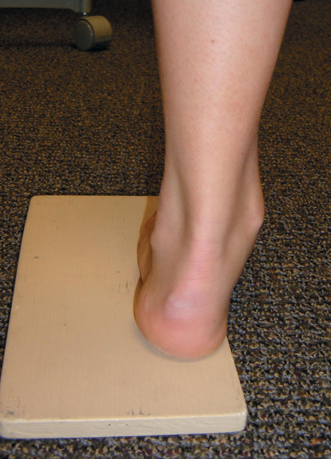 Fig. 19-6, Left foot viewed from the posterior upon a Coleman block. The heel and lateral forefoot are supported allowing the first ray to plantar flex relative to the lateral forefoot. Resultant hindfoot valgus is observed demonstrating a forefoot-driven cavus deformity.