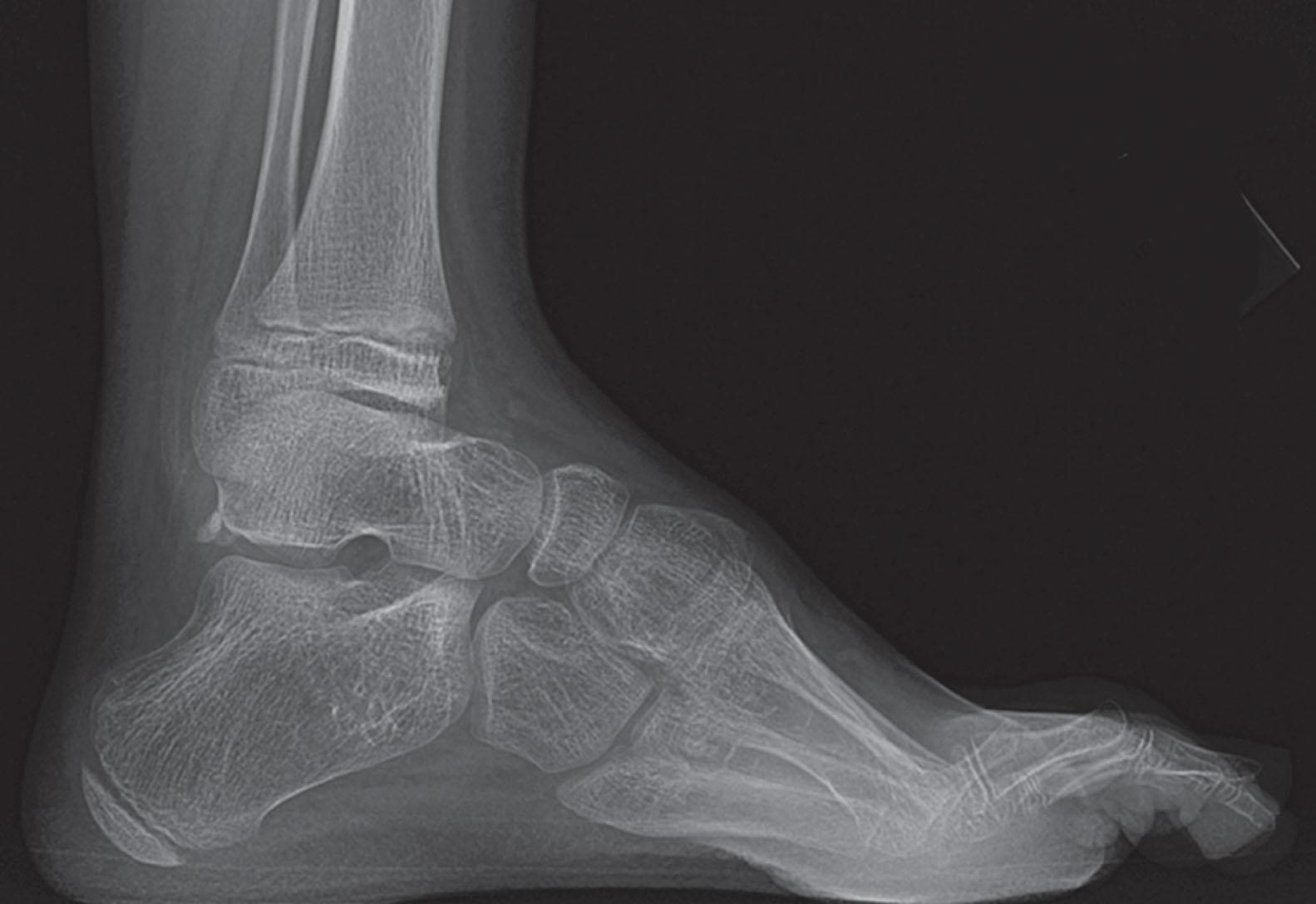 Fig. 19-7, Lateral radiograph of a juvenile patient with Charcot-Marie-Tooth disease demonstrating a severely plantar-flexed first metatarsal and oblique ankle, resulting from midfoot adduction relative to hindfoot.