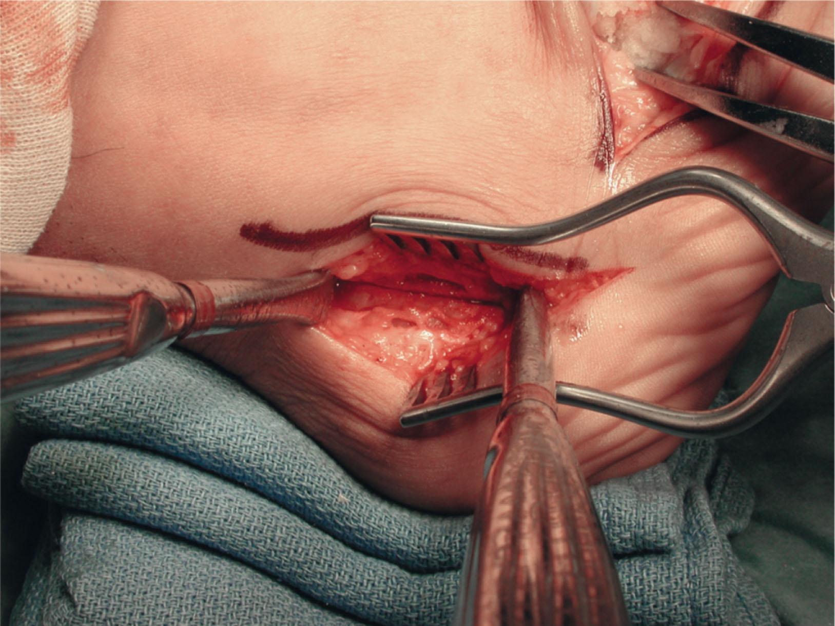 Fig. 19-9, Intraoperative photograph taken immediately after the osteotomy of the calcaneus but before it is shifted laterally out of varus.