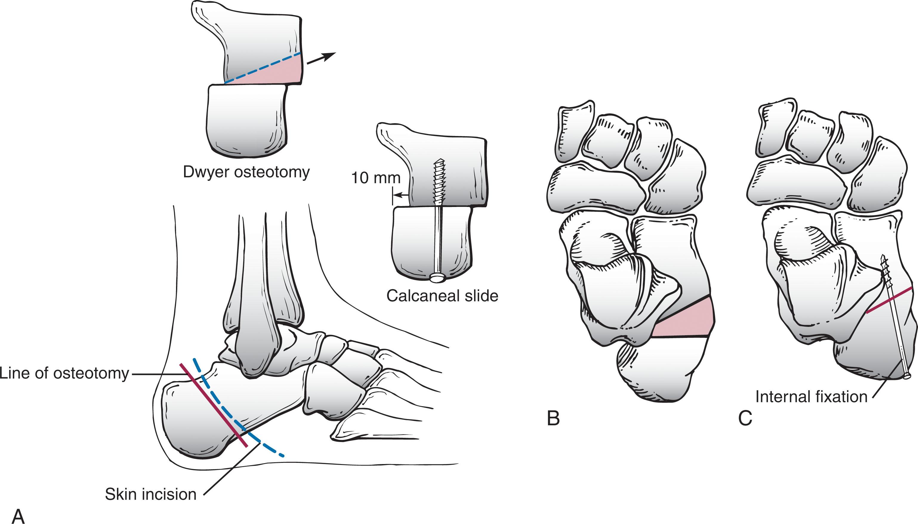 Fig. 19-10, Dwyer calcaneal osteotomy. A , Skin incision is made halfway between the palpable Achilles tendon and the peroneal tendons, after the sweep of the peroneal tendons. The sural nerve must be identified and protected. B , Two oblique osteotomies are carried out as closing-wedge procedures. The base of the closing wedge increases to correct the increasing varus deformity. C , The wedge is removed, the osteotomy site is closed, and internal fixation is accomplished.