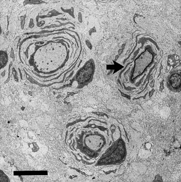 Figure 16.5, Sural nerve biopsy of 4½-year-old girl with a DSD phenotype due to a PMP22 missense mutation. Large onion bulbs are seen around demyelinated and remyelinated (arrow) fibers. Marked increase in endoneurial collagen. Bar=5 μm.