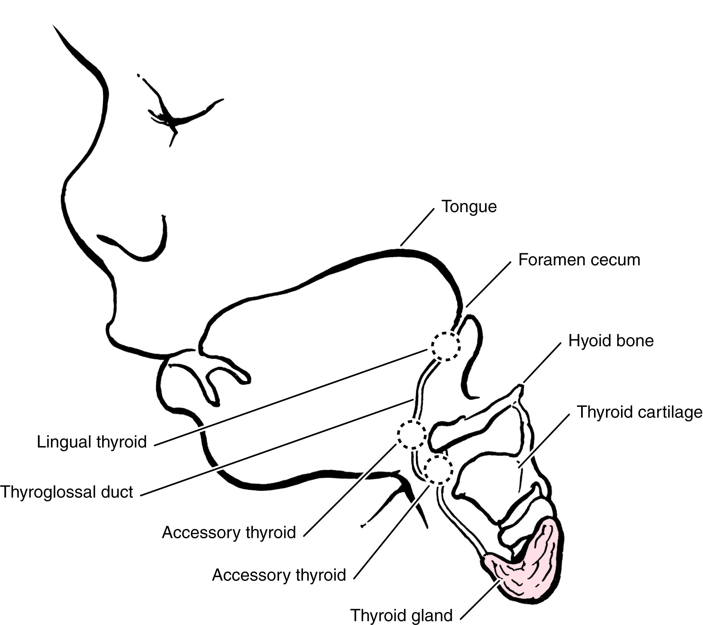 Fig. 23.9, Migration of thyroid tissue.