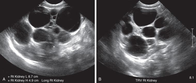 Figure 113.1, Multicystic dysplastic kidney in a 1-day-old boy.