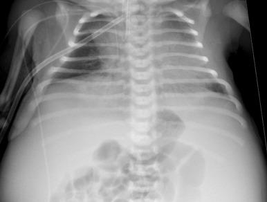 e-Figure 113.7, Autosomal recessive polycystic kidney disease in a newborn boy.