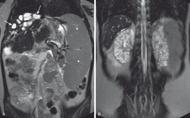 e-Figure 113.12, Autosomal recessive polycystic kidney disease with severe liver involvement.